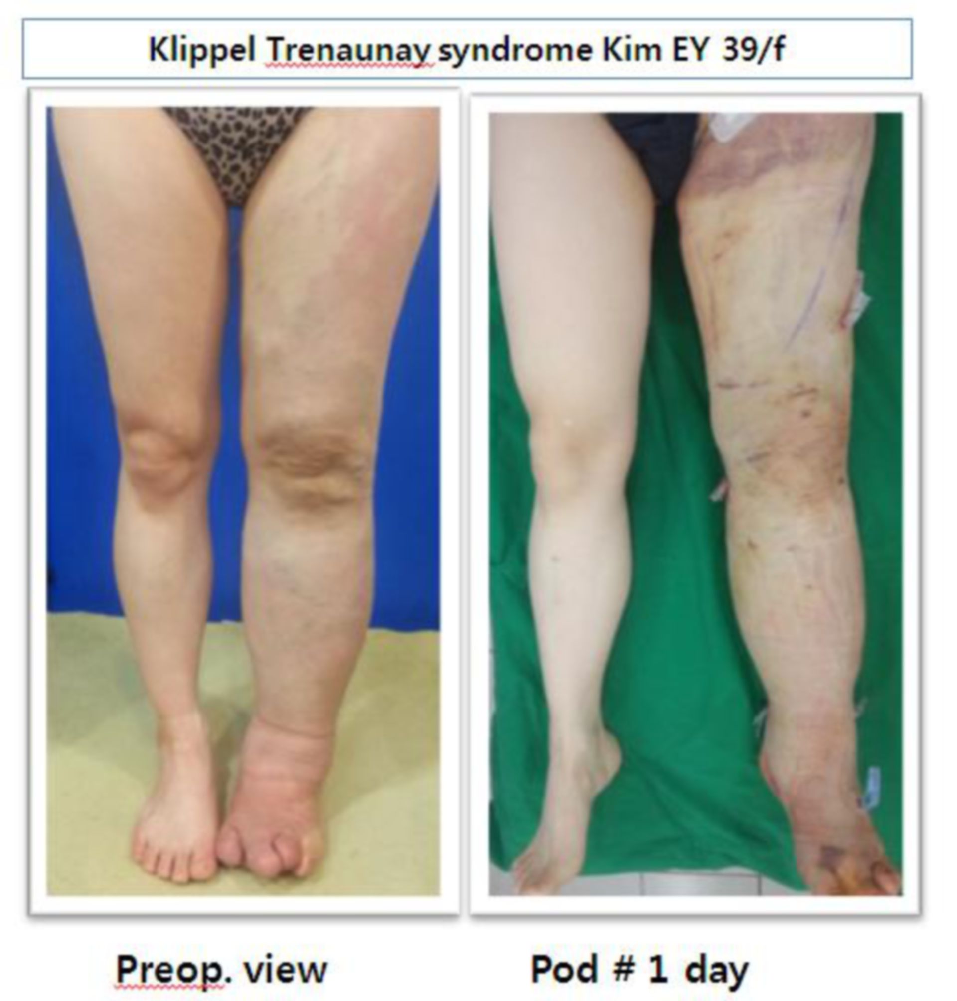 La sindrome di Klippel Trenaunay linfedema 39 / f (Yonsei S Hospital, Seoul, Korea)