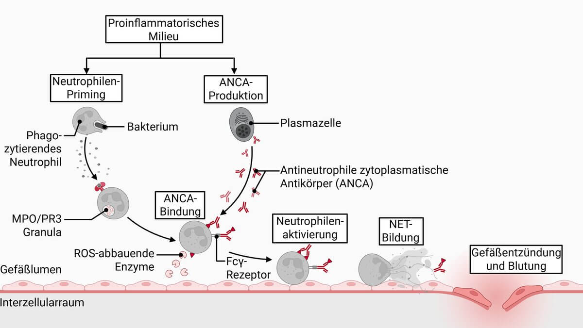 ANCA-assoziierte Vaskulitis