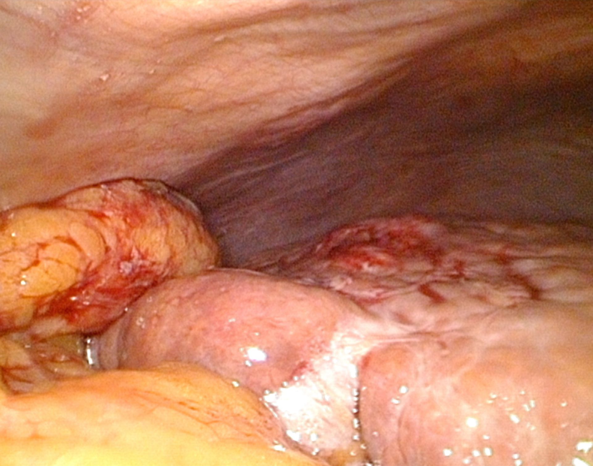 La cirrosi epatica con HCC in 7 segmenti