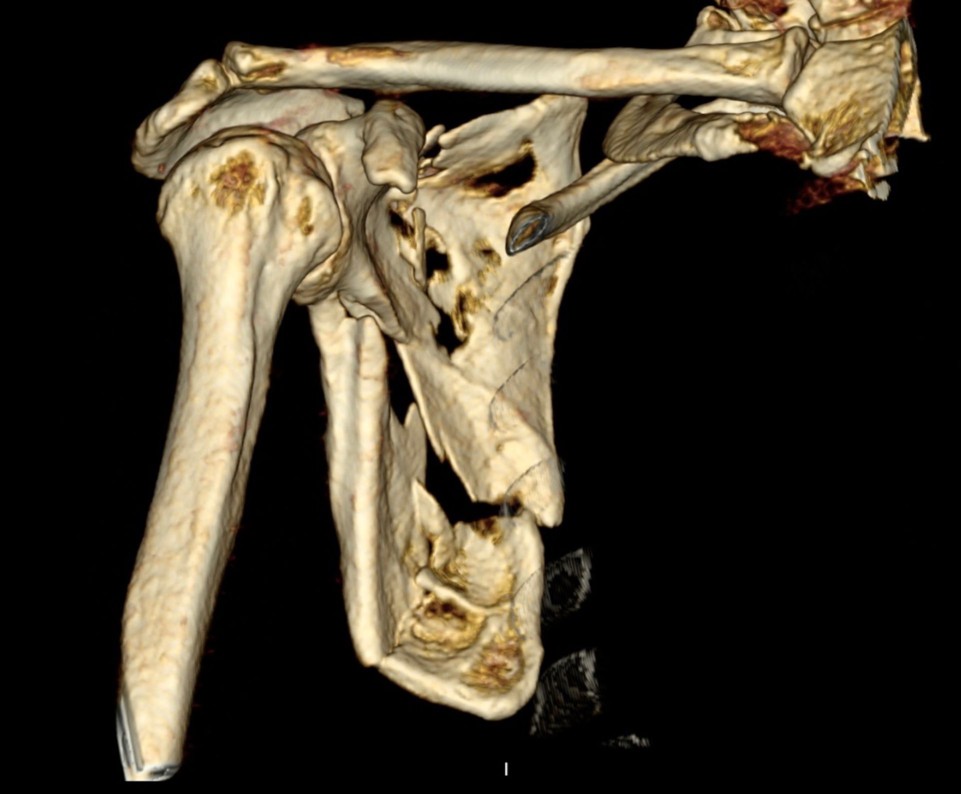 3D-Rekonstruktion einer CT des Schultergürtels mit einer Scapulatrümmerfraktur.