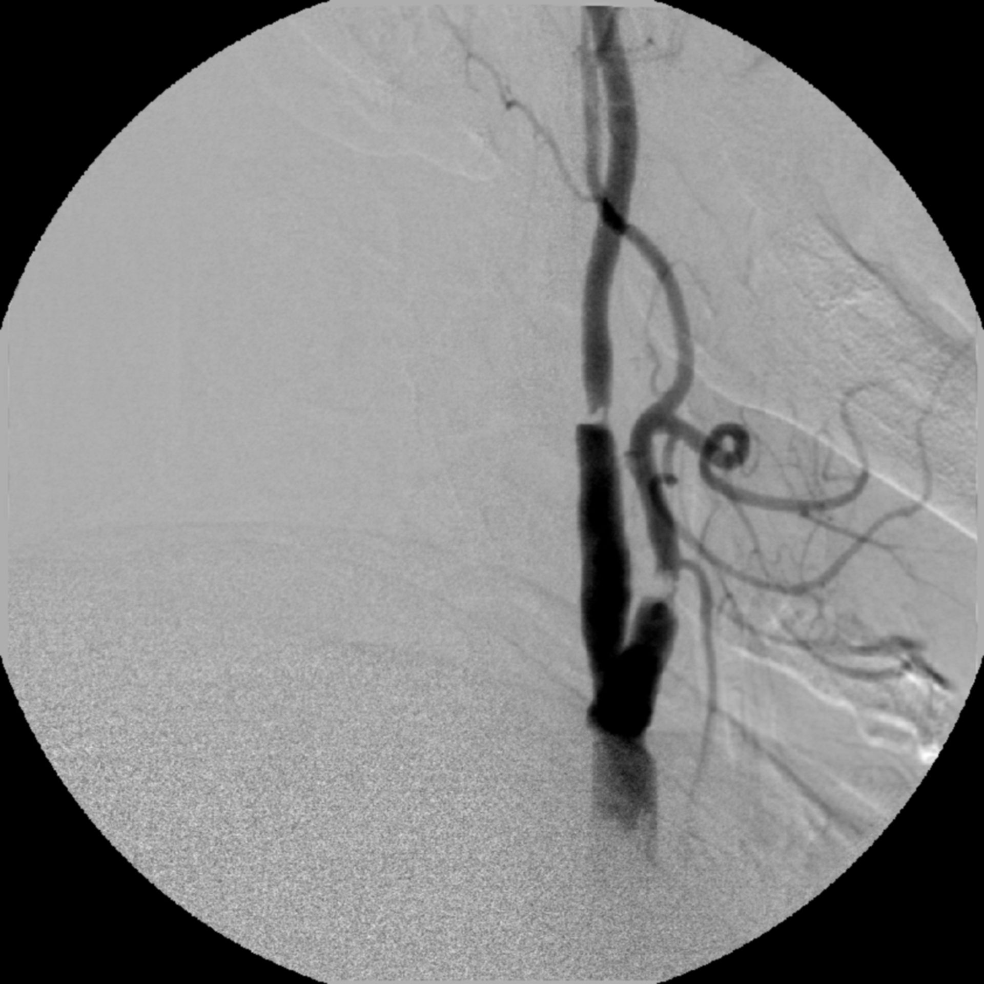 Early relapse due to intima flap after TEA of the carotid artery.
