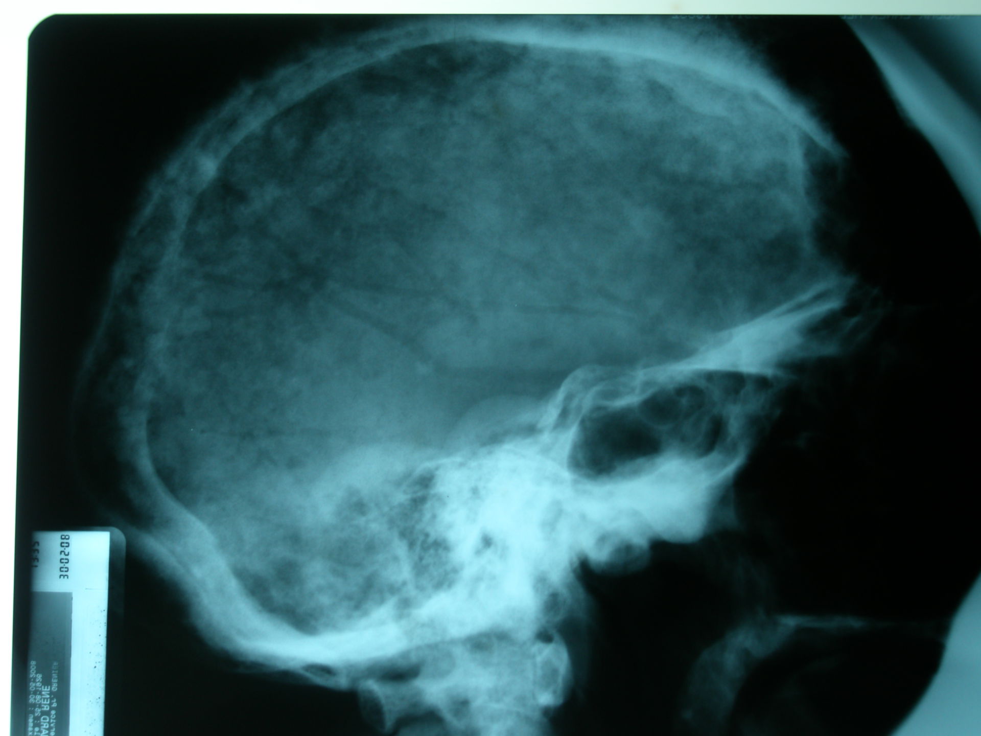 Il morbo di Paget dell'osso, Cranio 2