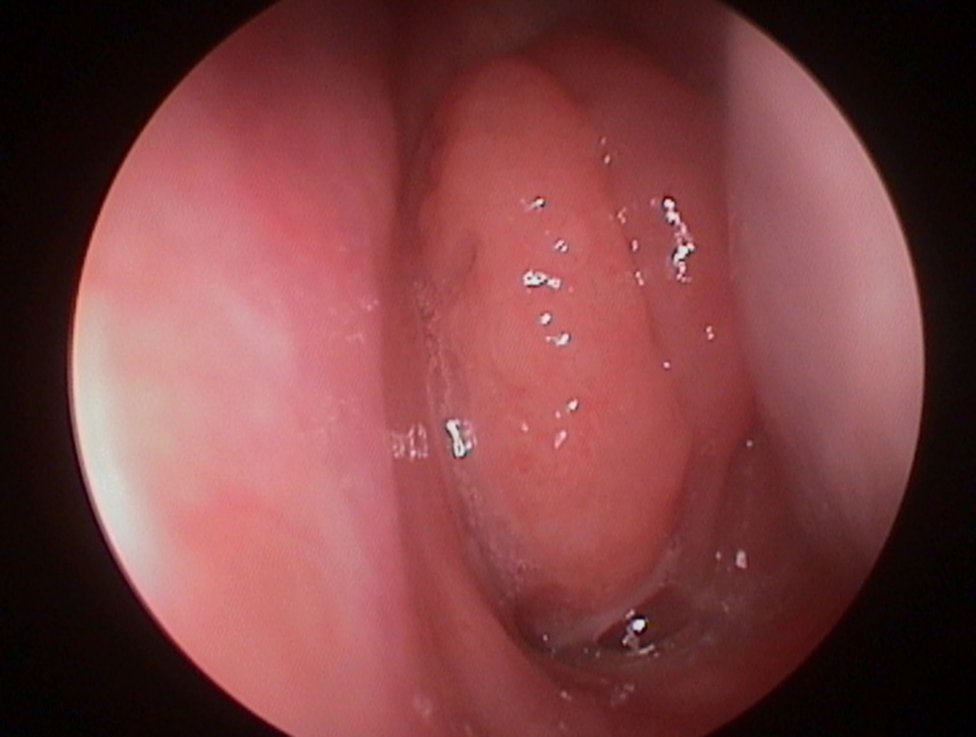 Large pharyngeal tonsils