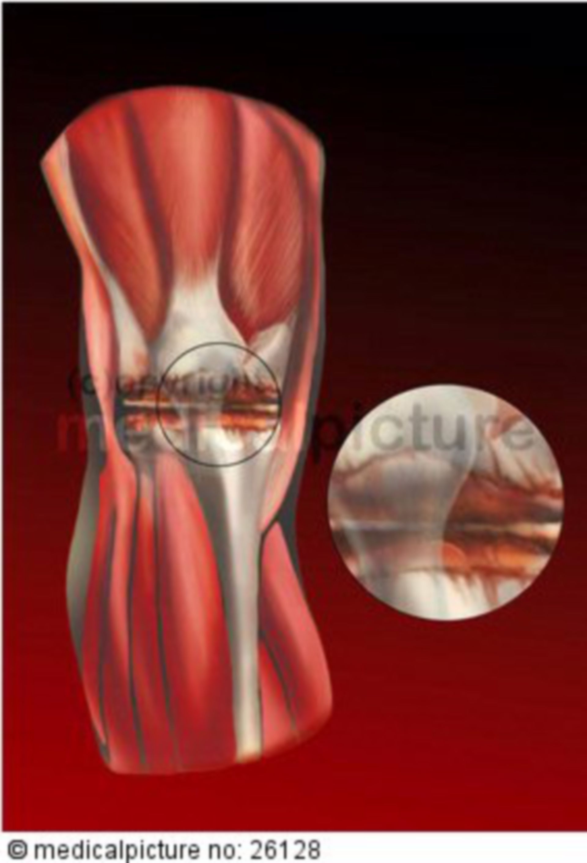 Arthritis of knee joint