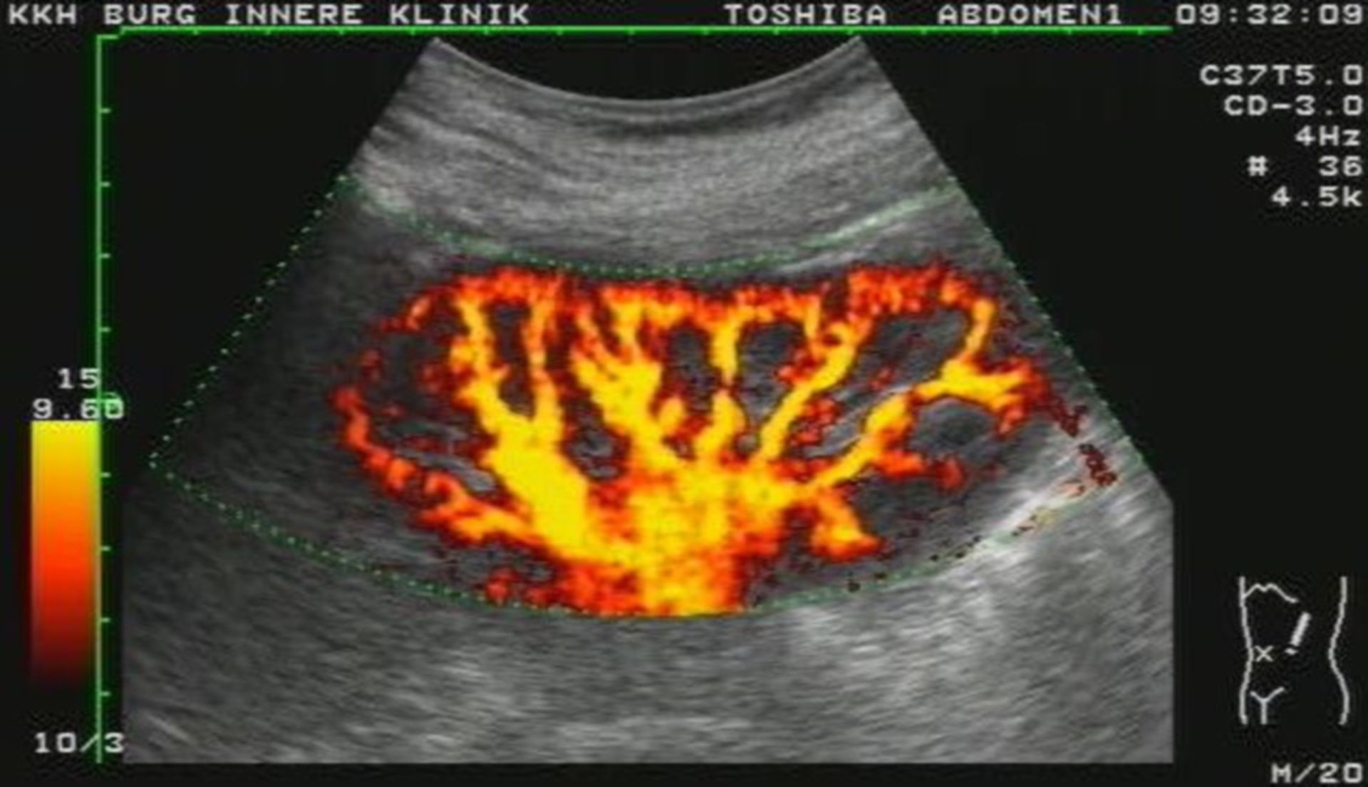 Kidney - Power Doppler imaging