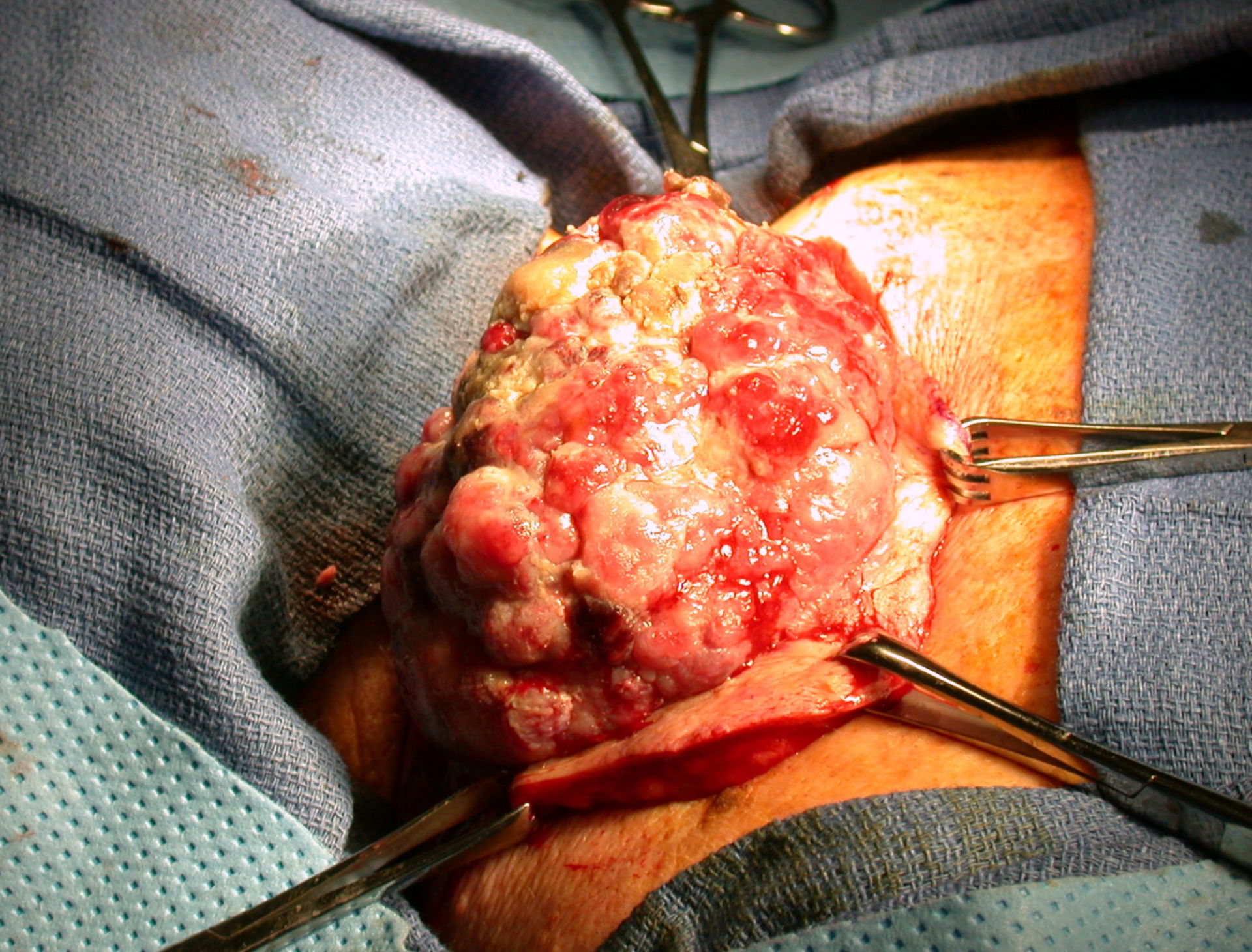 Recurrent Malignant Melanoma, Upper Back