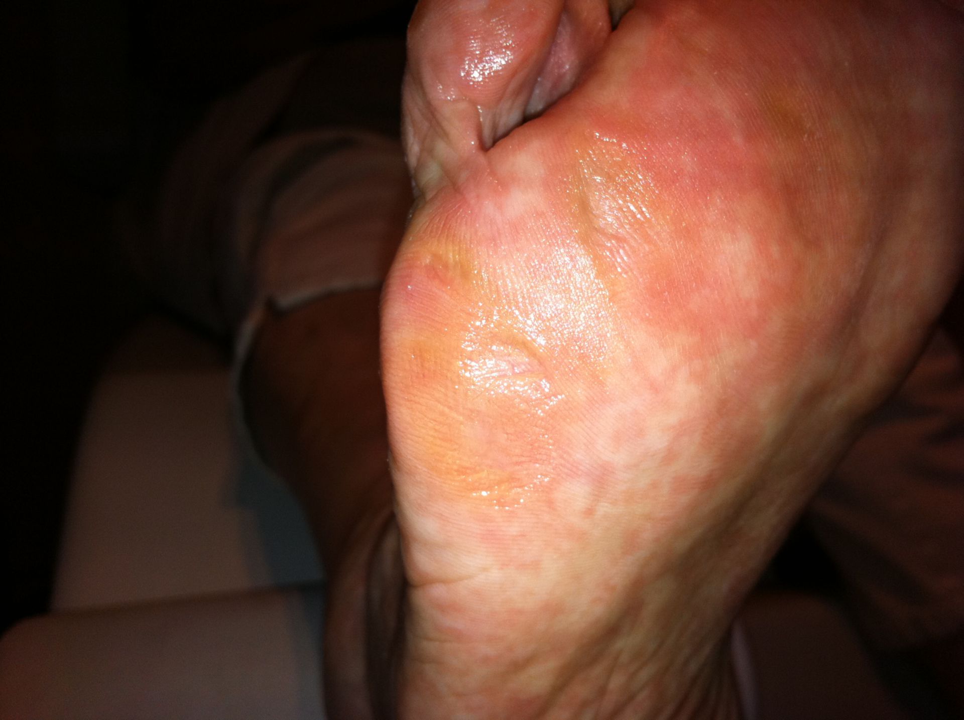 Callus after removal