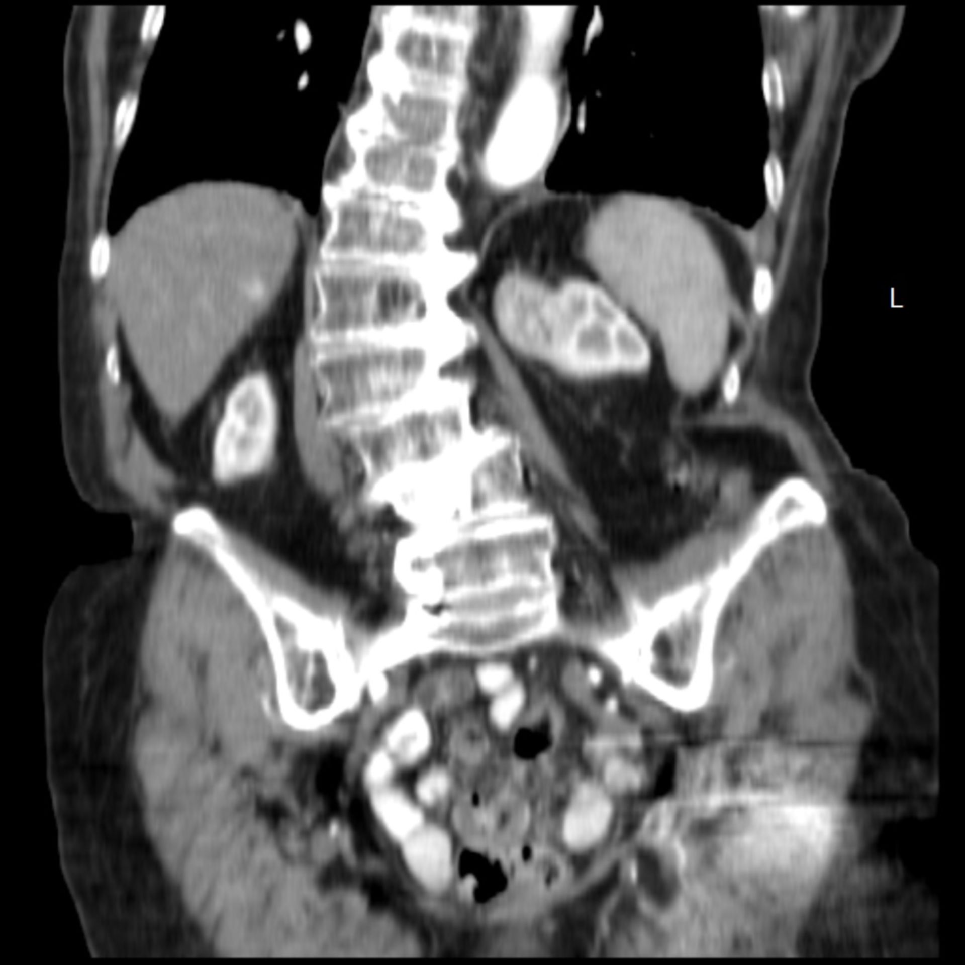 ct_abdomen4: CT des Abdomens in frontaler Ebene