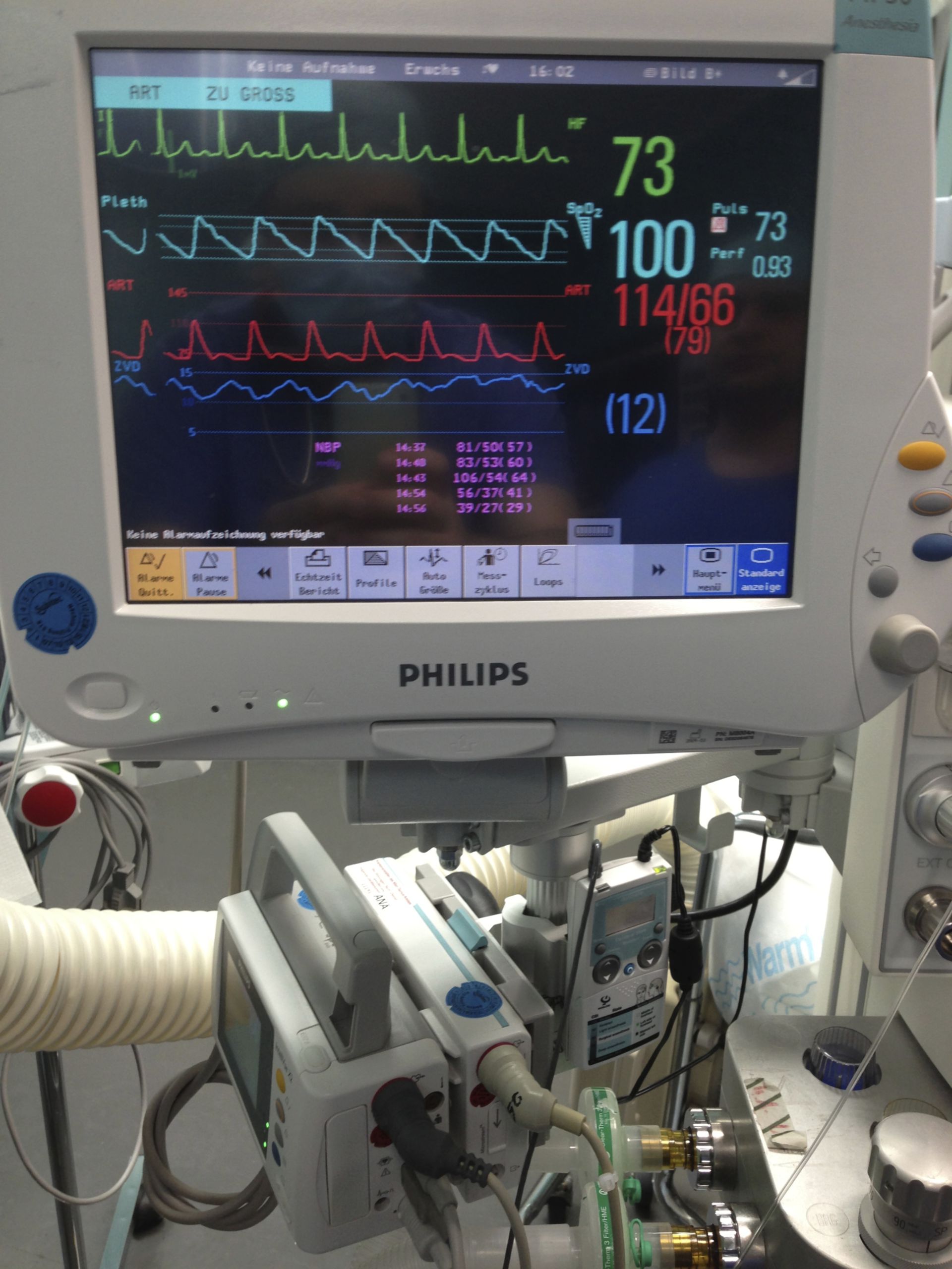 Schermata di monitoraggio del paziente sul posto di lavoro anestesiologico