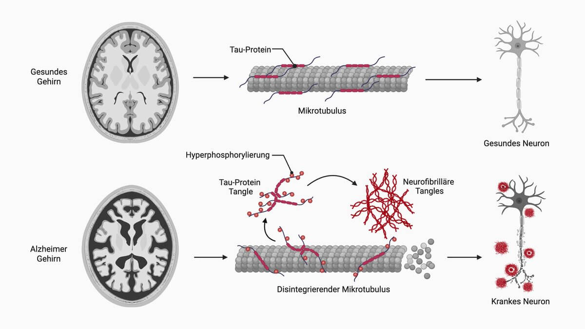 Alzheimer Pathologie
