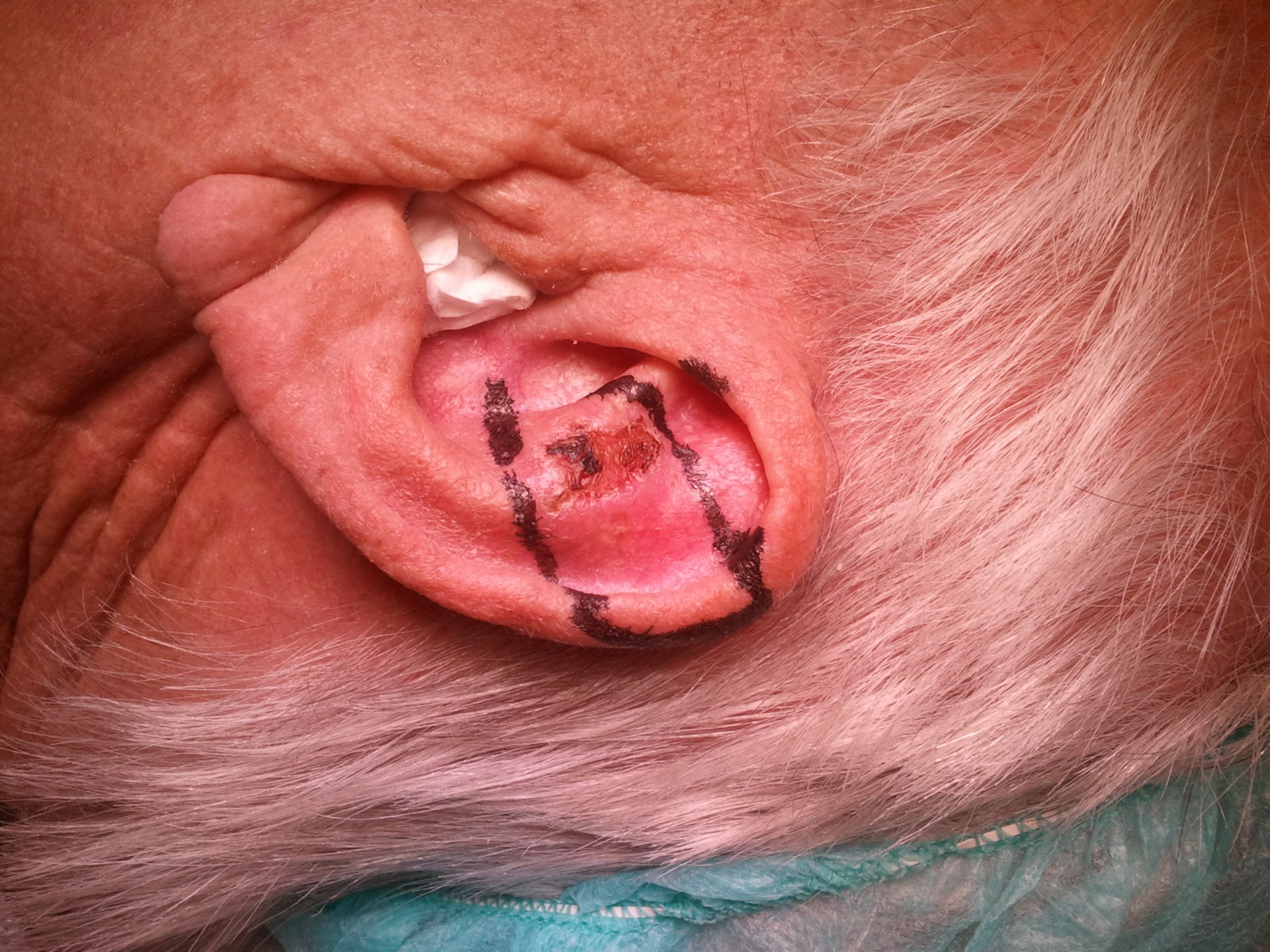 Basalzellkarzinom linkes Ohr-Schnittmarkierung