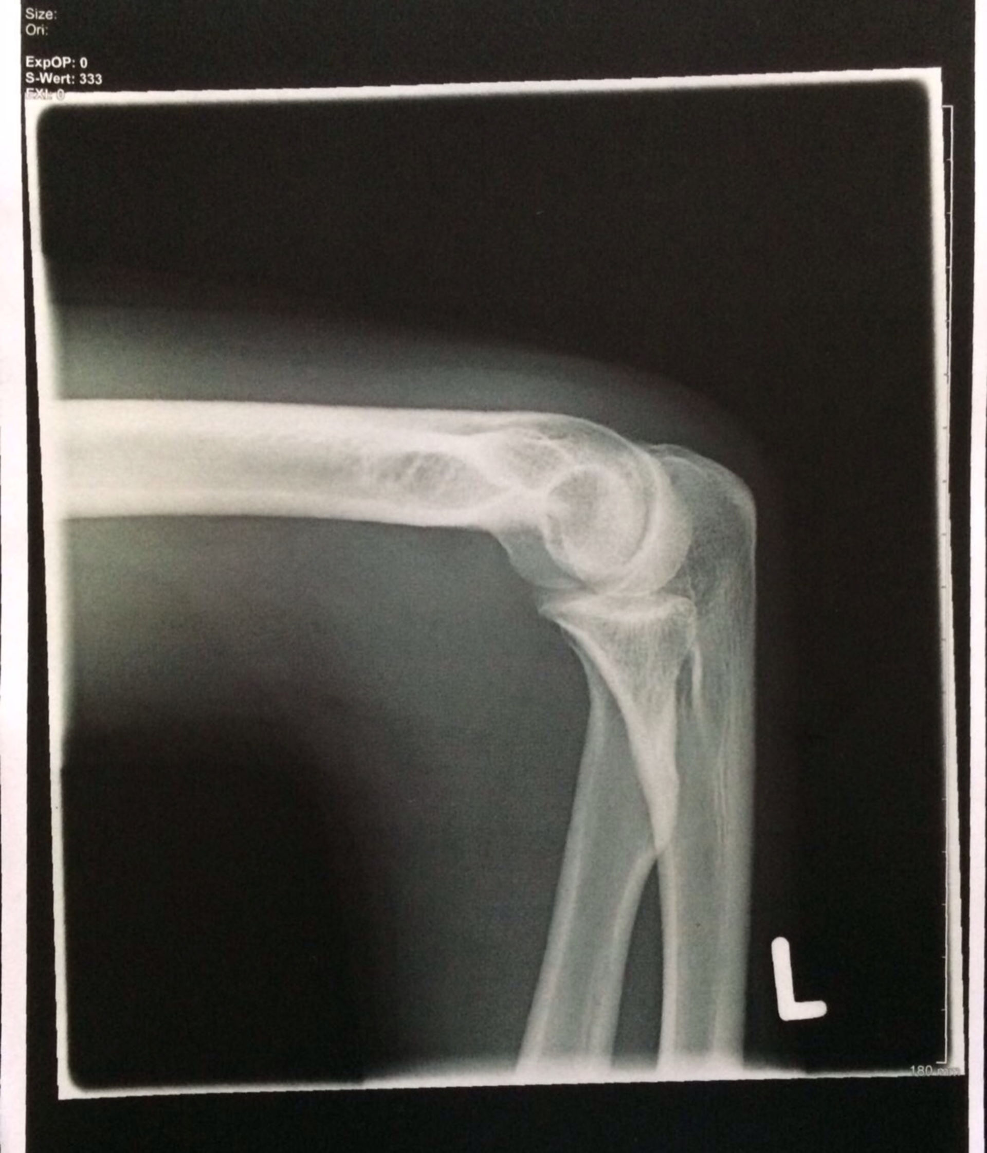 Röntgenbild Ellenbogen