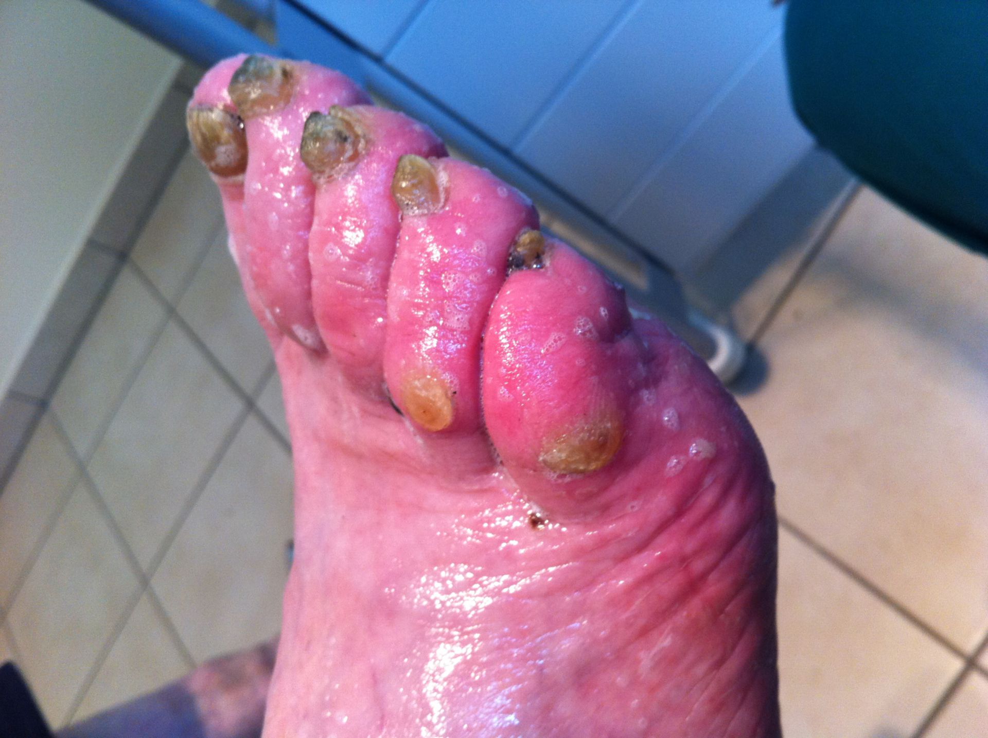 Long time no podiatry care