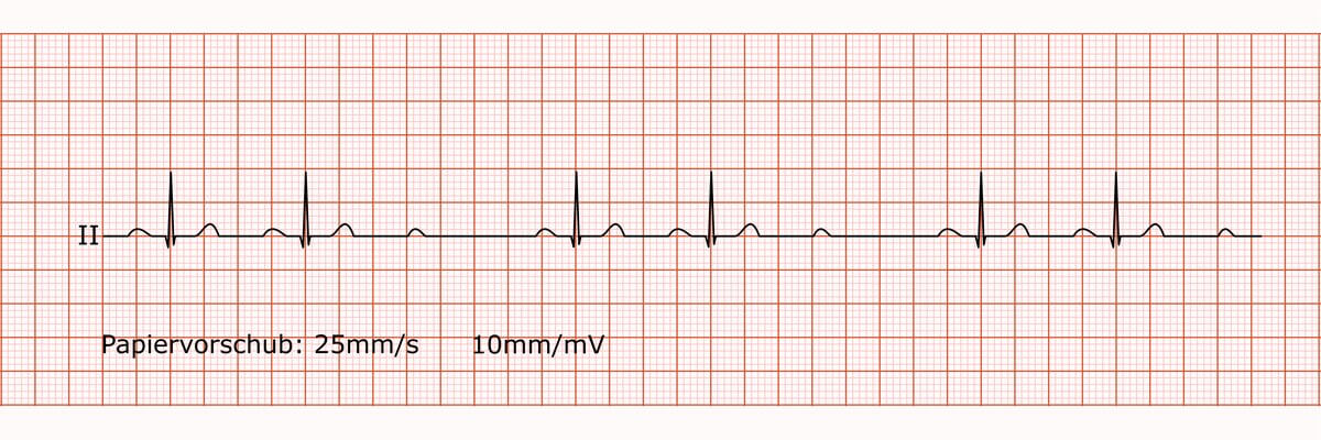 Rhythmusstreifen bei AV-Block 2. Grades Typ Mobitz II