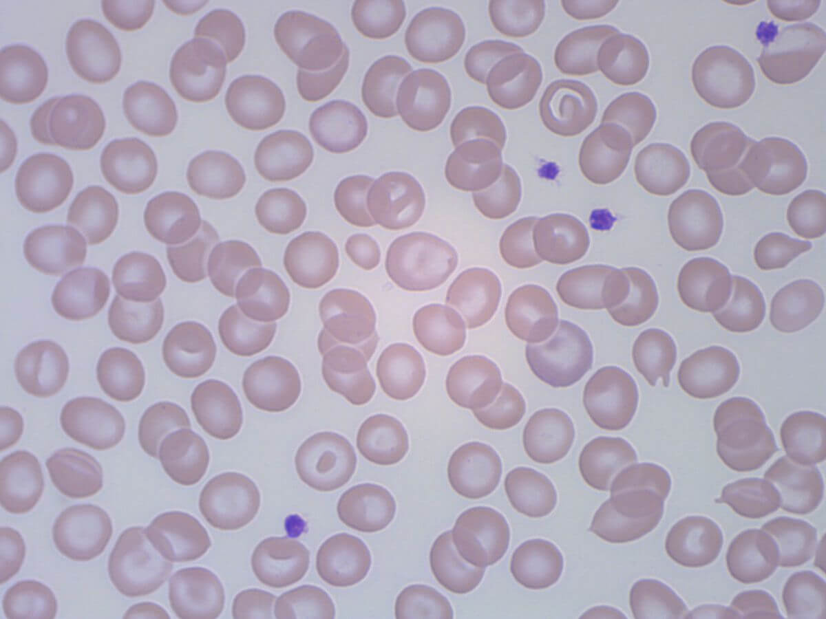 Blutausstrich mit Targetzellen
