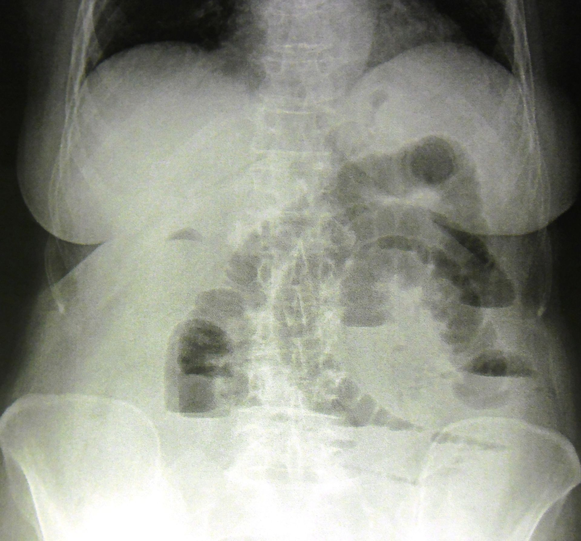 intestinal obstruction due to small bowel adhesions