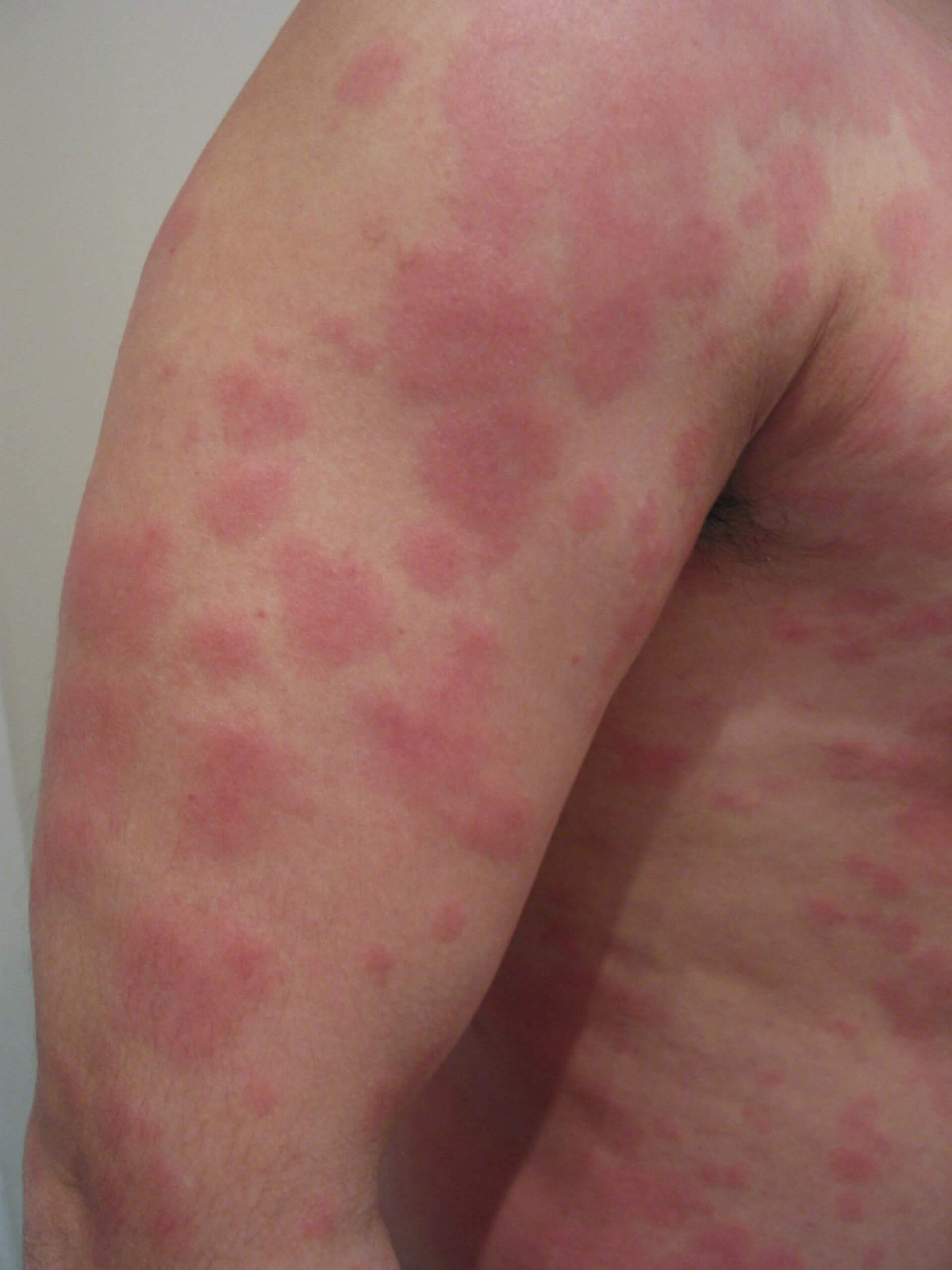 akute-urticaria-300ppi_lg_original.jpg