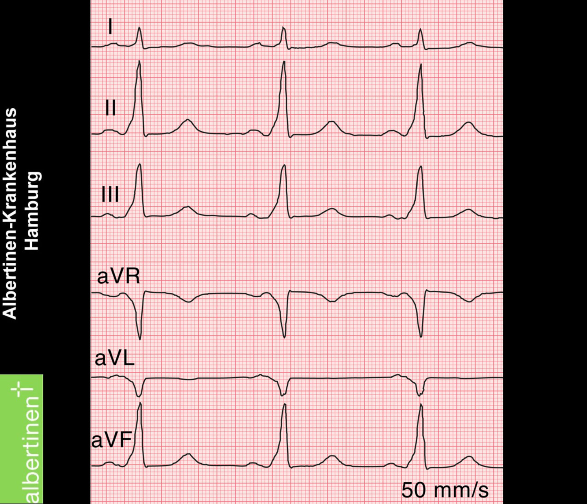 Delta Wave On EKG