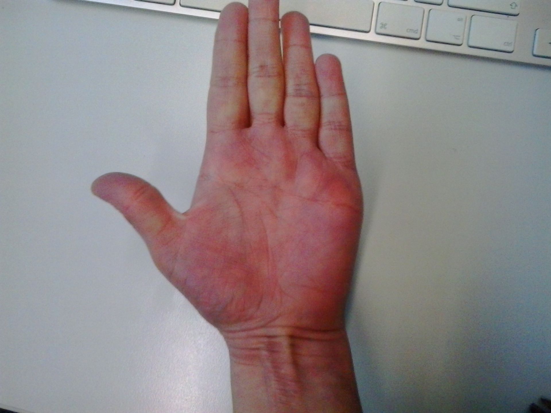 Unbekannte Rötung beider Hände (3)