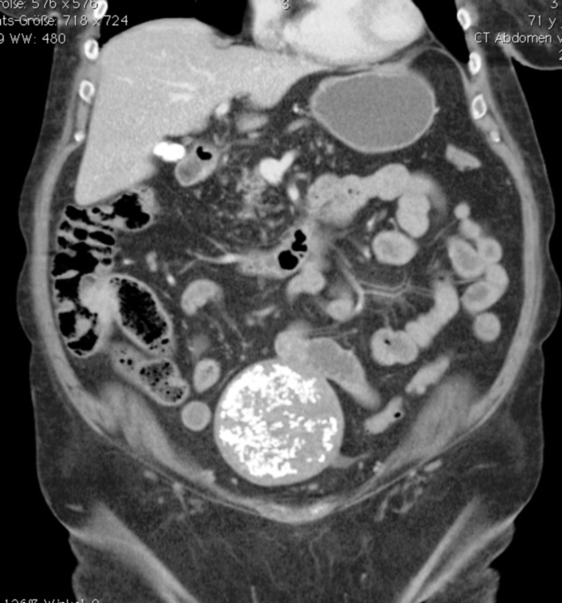 Unterbauch-Tumor:verkalktes Uterusmyom