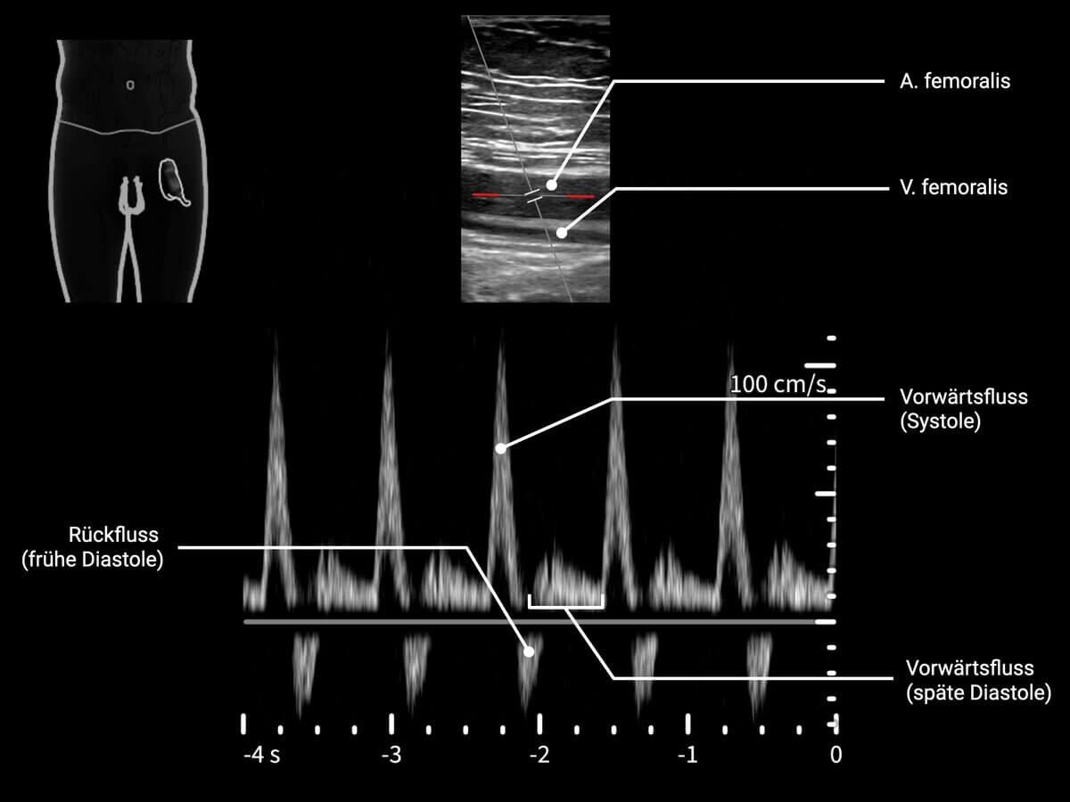 Doppler-Sonographie der A. femoralis