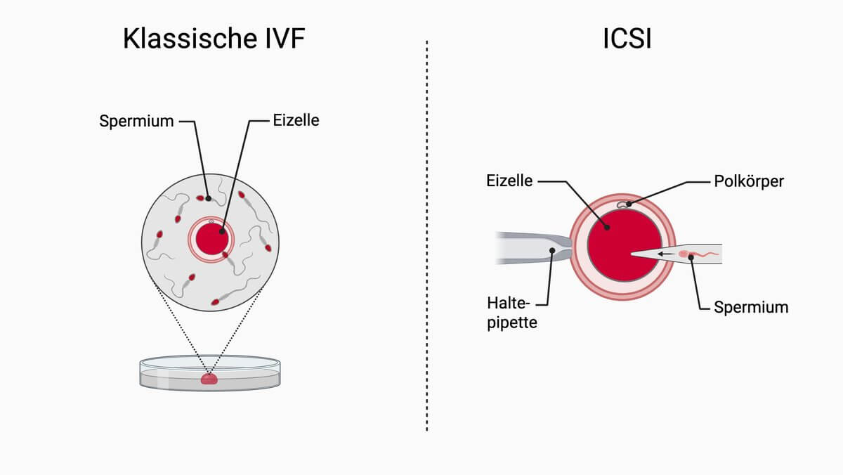 Vergleich Klassische IVF und ICSI