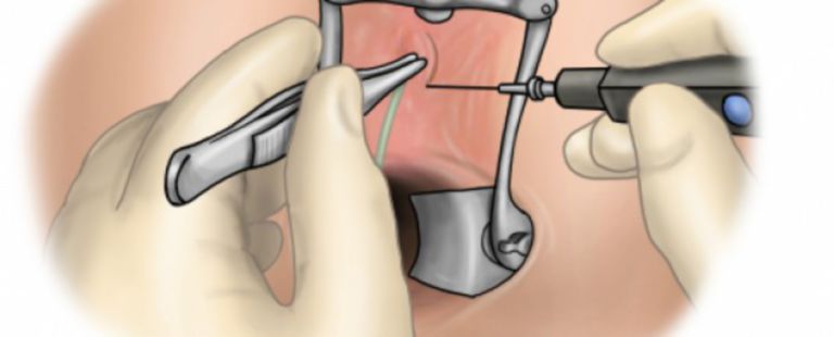 anal fistula plug Introduction of the anal fistula plug with fixing button into the