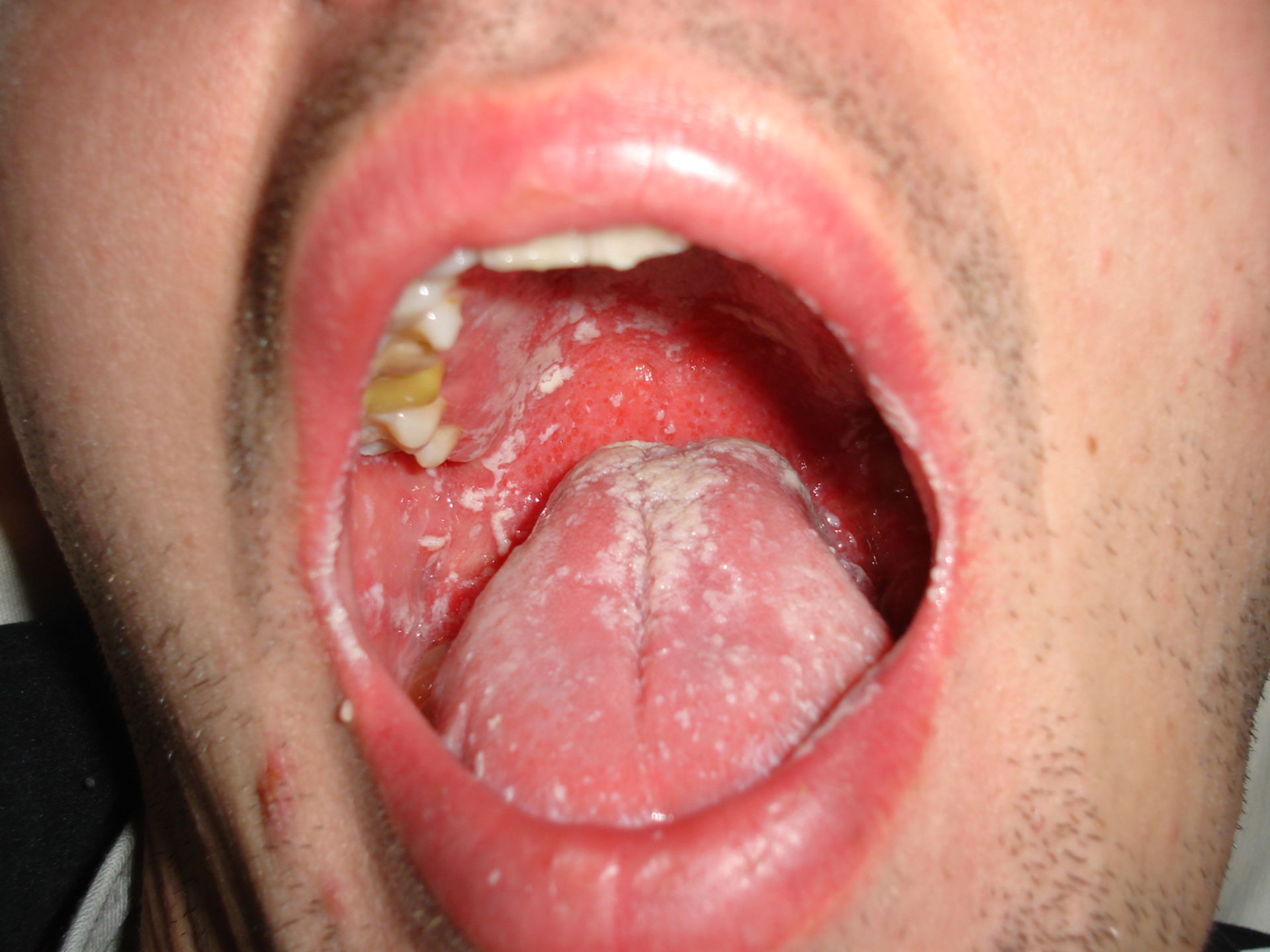 orale Candidose