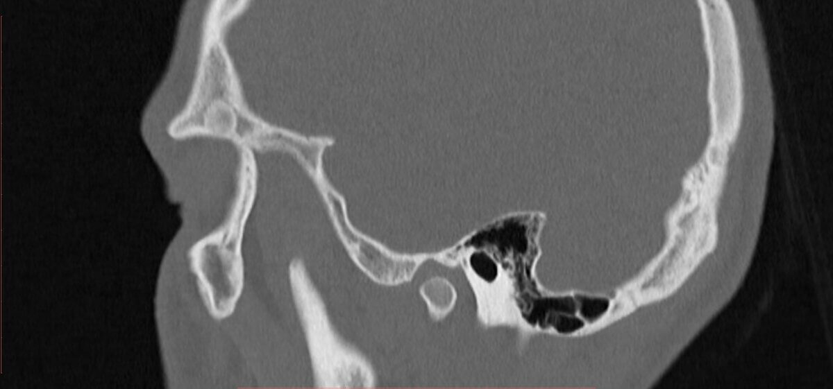 Osteom des Os zygomaticum (NNH-CT, Sagittal)