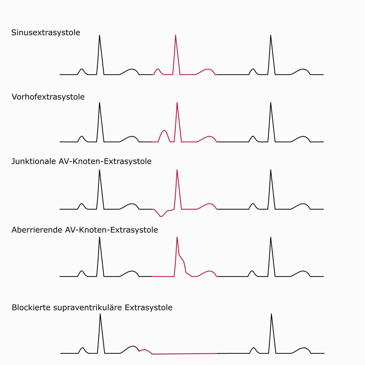 Schematische Darstellung von supraventrikulären Extrasystolen