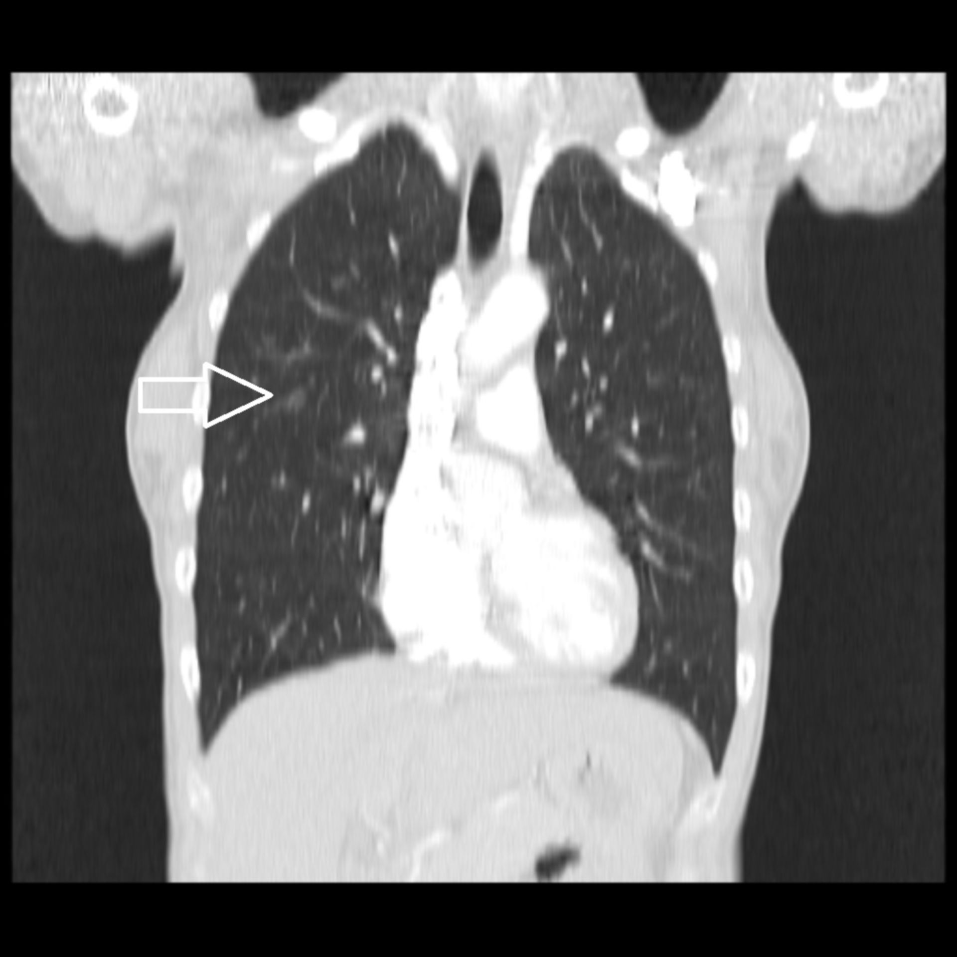 ct1_cor2: CT des Thorax in frontaler Ebene.