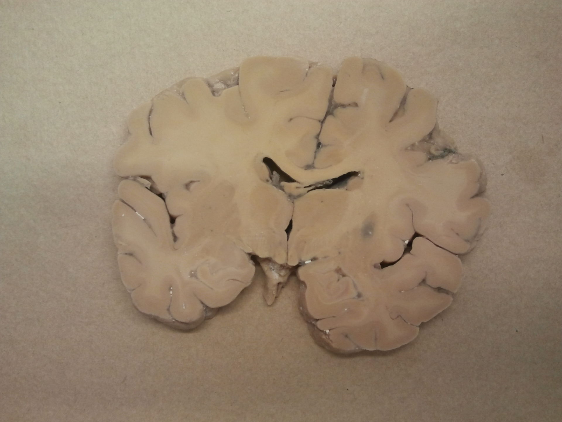 Sezione del cervello con ventricolo laterale con insula C