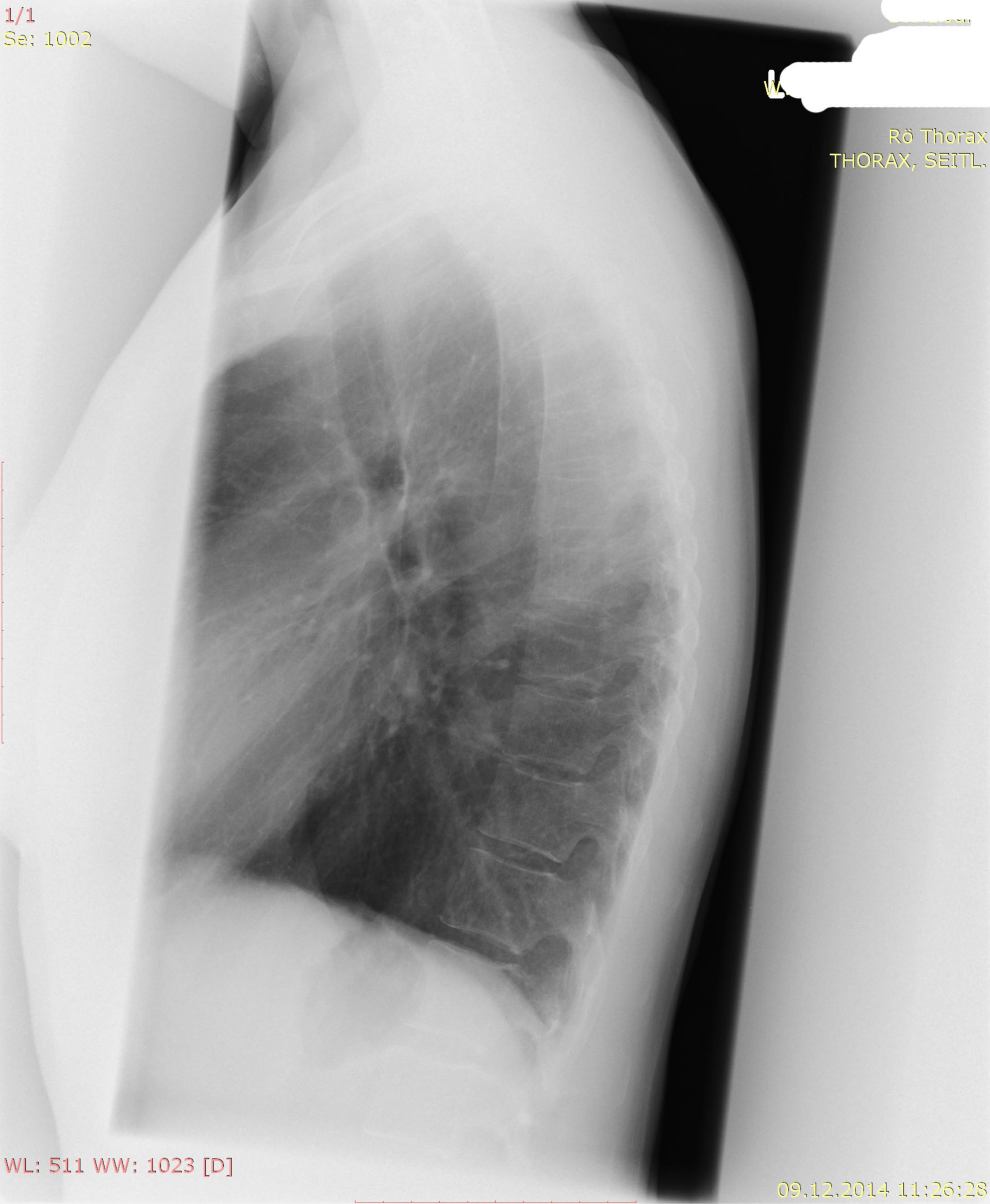 X-ray thorax 2