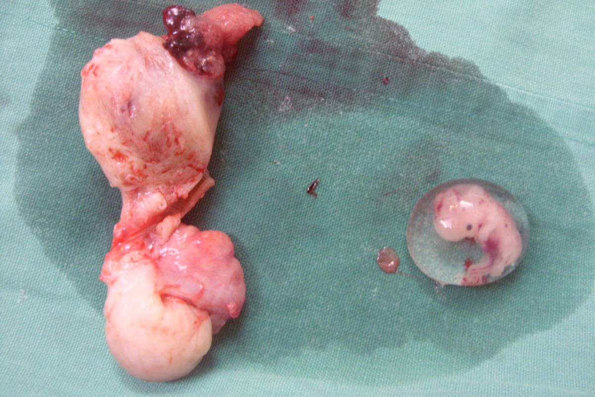 Embryo (Eileiterschwangerschaft, 6. Woche p.c., 8. SSW)