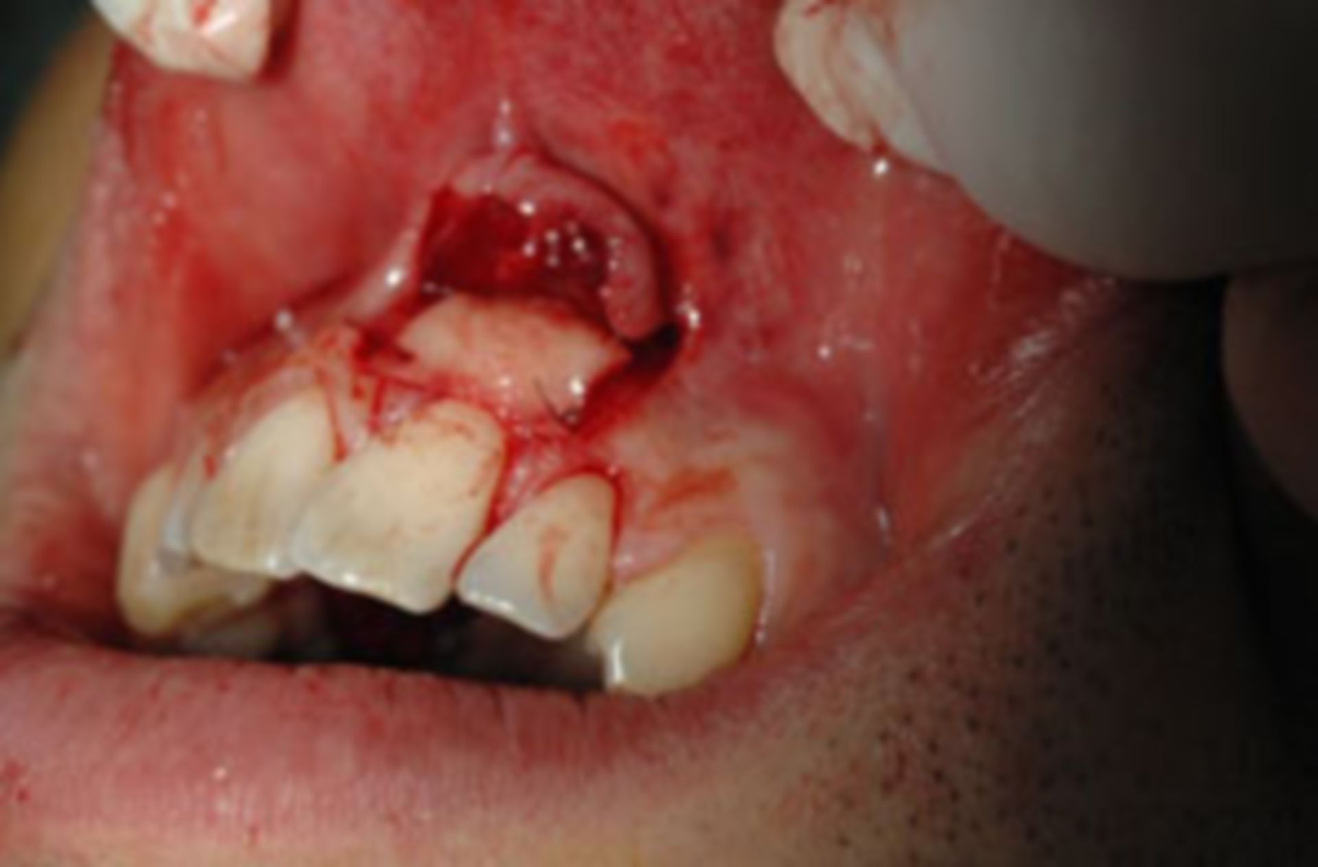 Intraoraler Befund mit blutiger Verletzung des Zahnfleisches