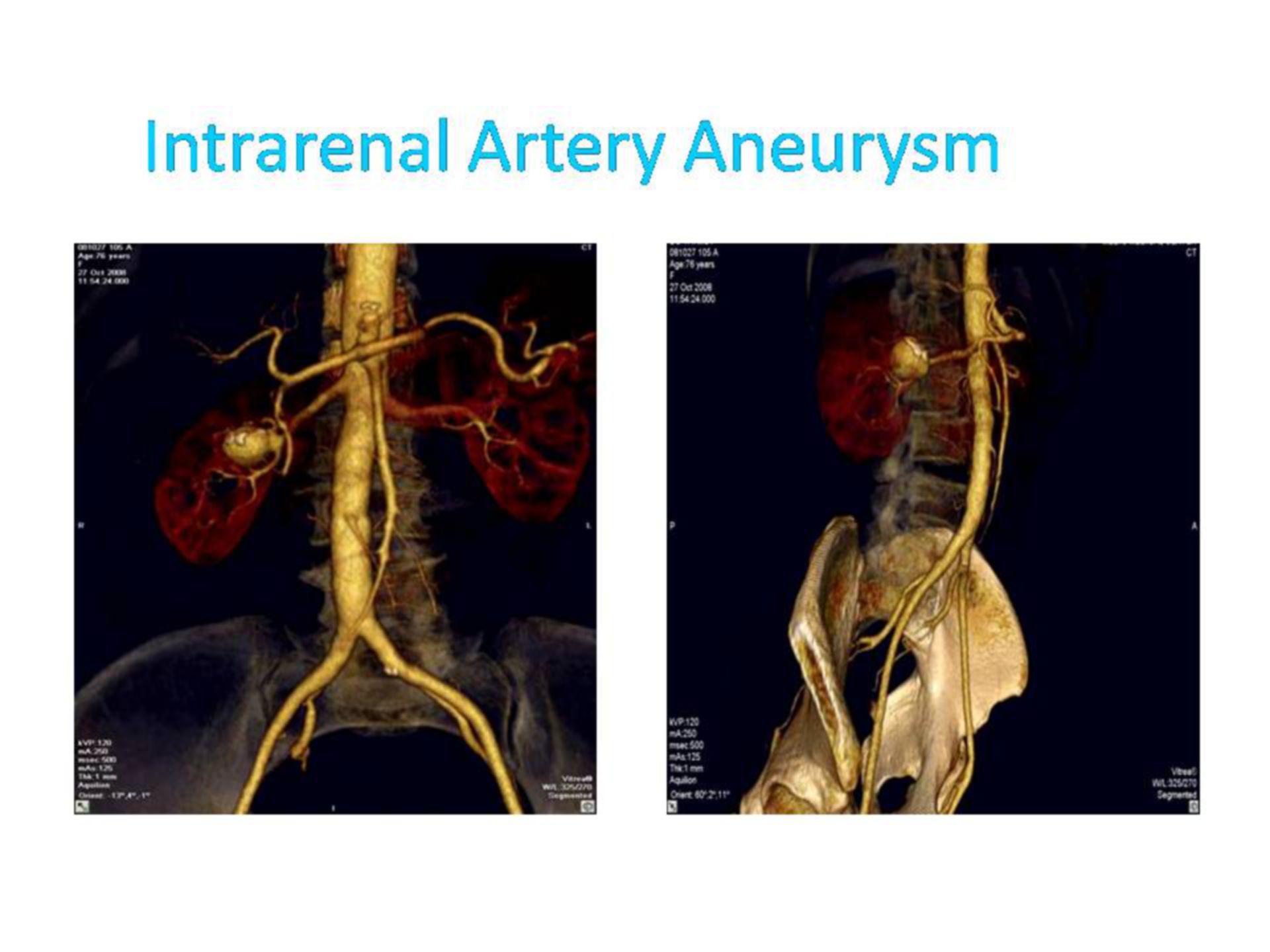 Aneurisma de la arteria renal (2)