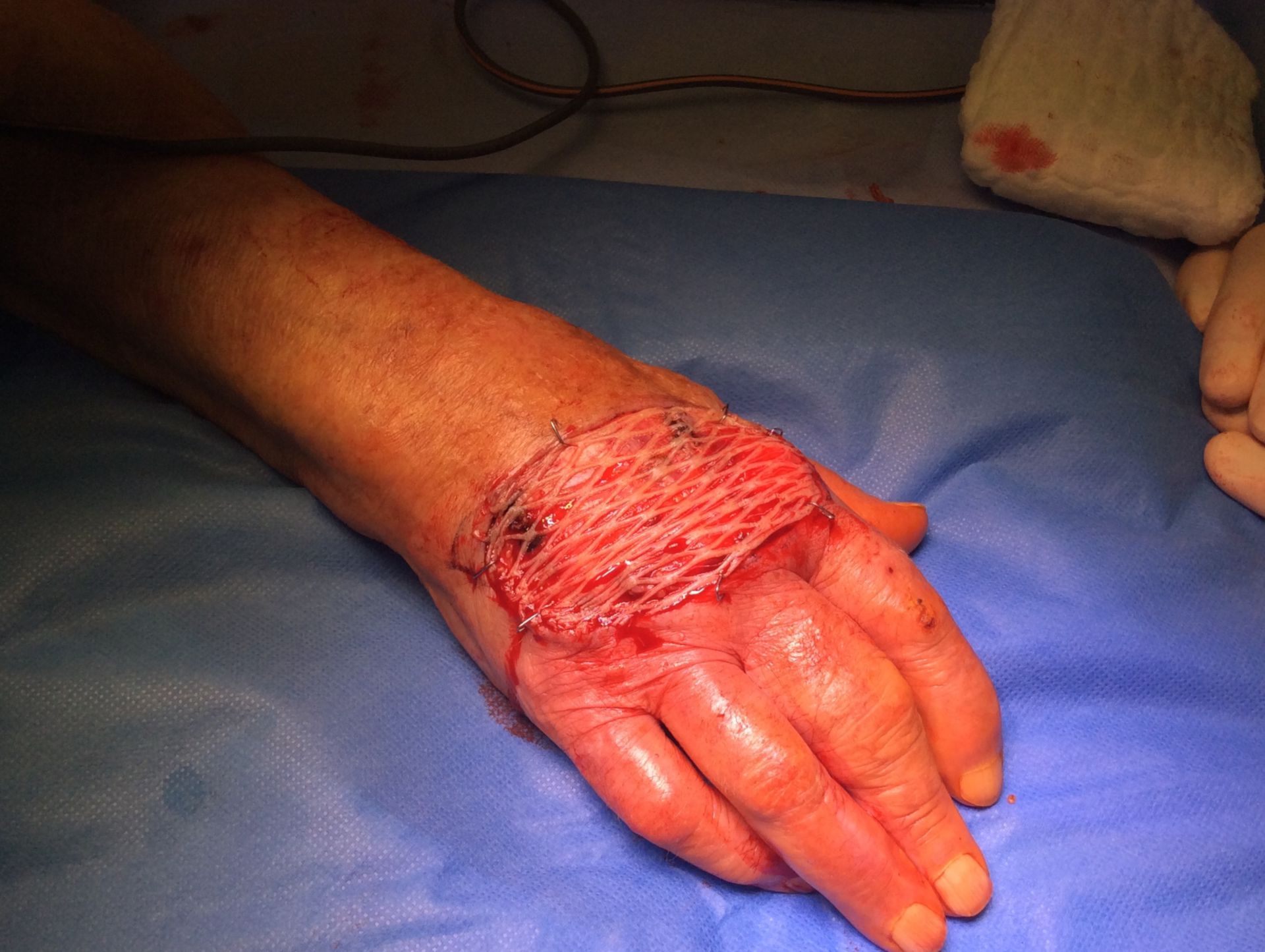 Plattenepihel Ca. der Hand-Situs nach Hauttransplantation
