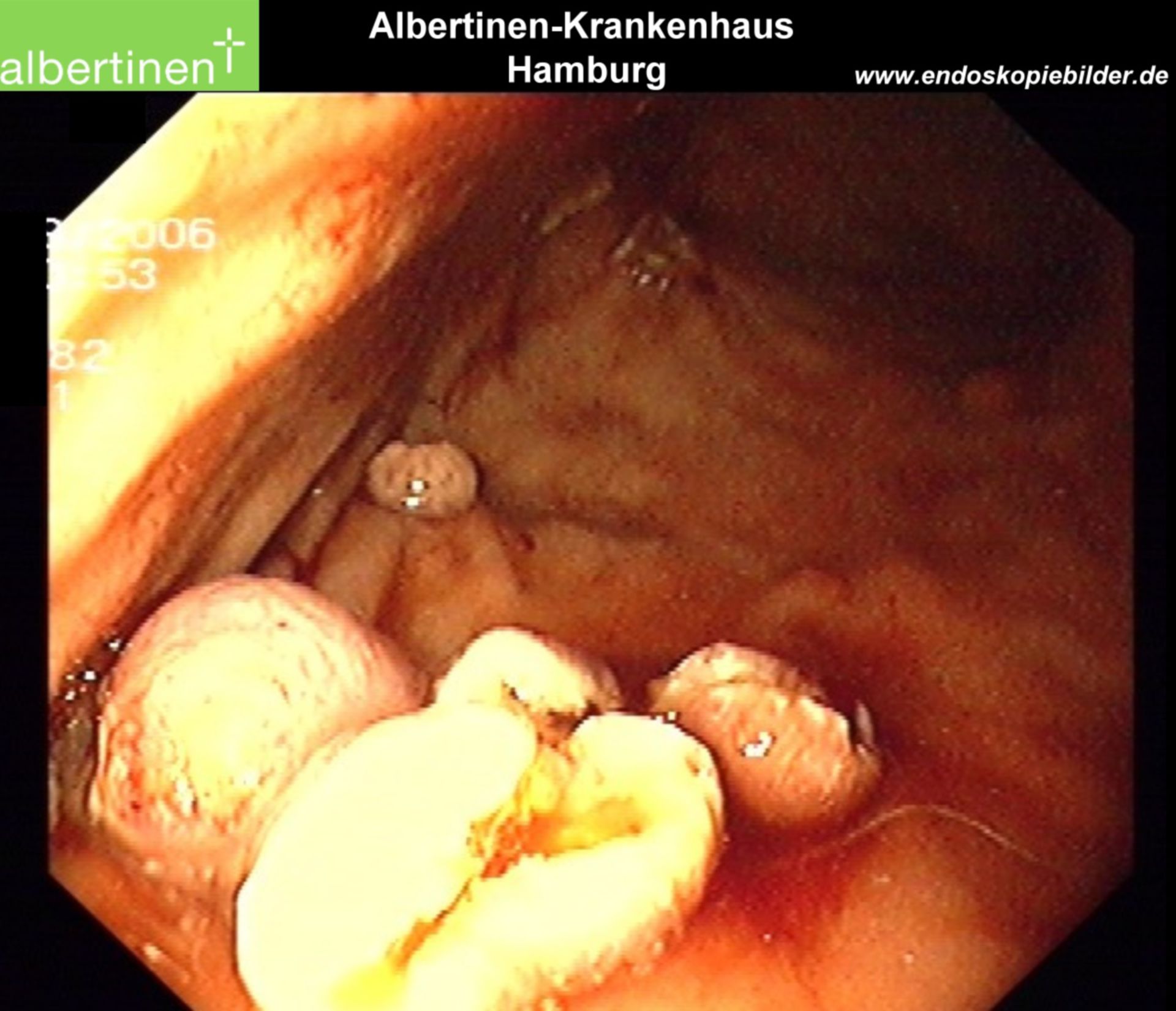 Carcinoid abgetragen Magen Endo
