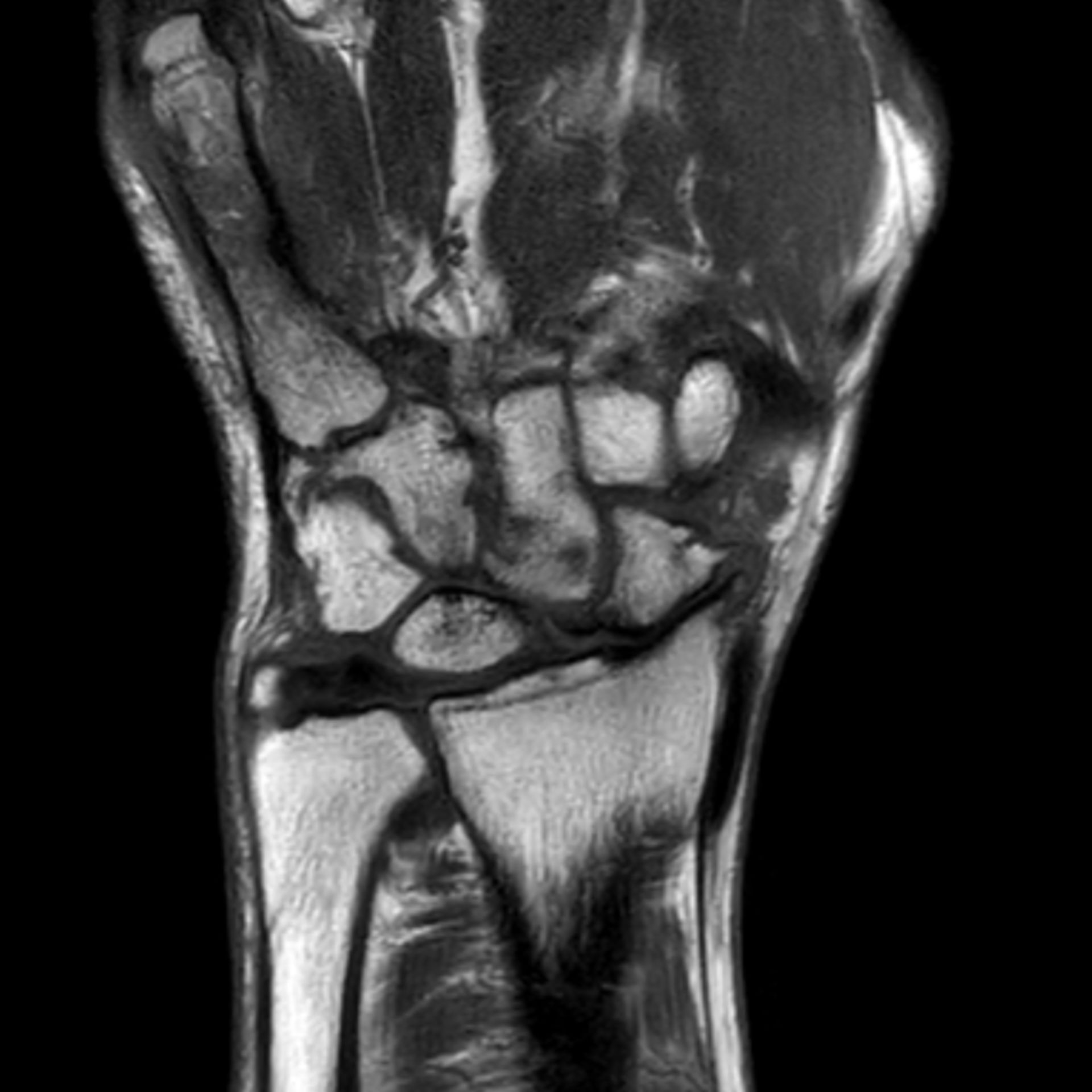 Deformierende Arthrose der Handwurzelknochen (t1_cor)