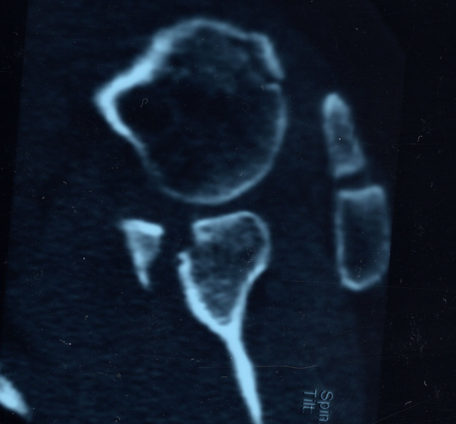 Fracture of the shoulder glenoid