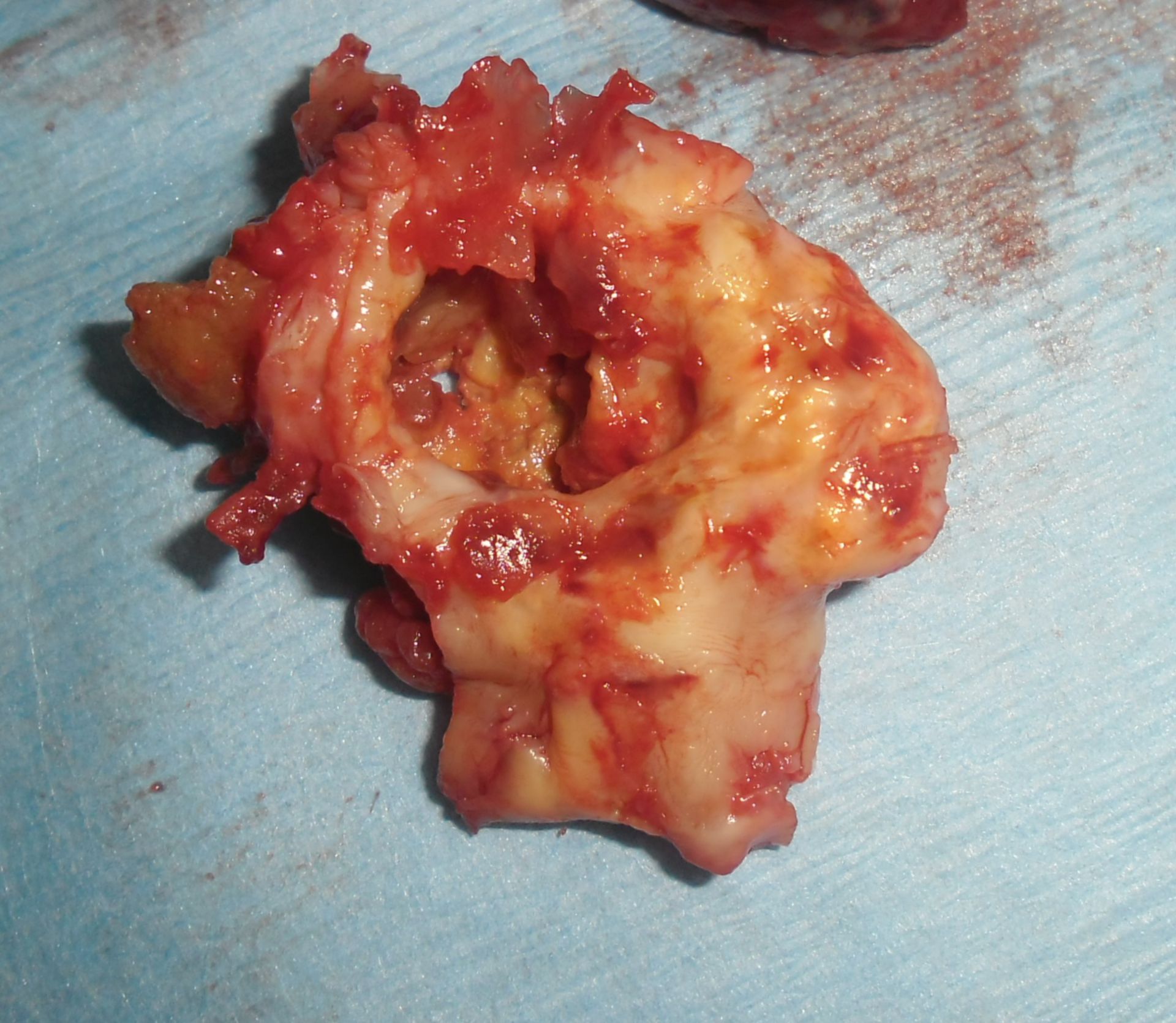 Aneurysma A poplitea - aufgeschnitten ohne Thrombus