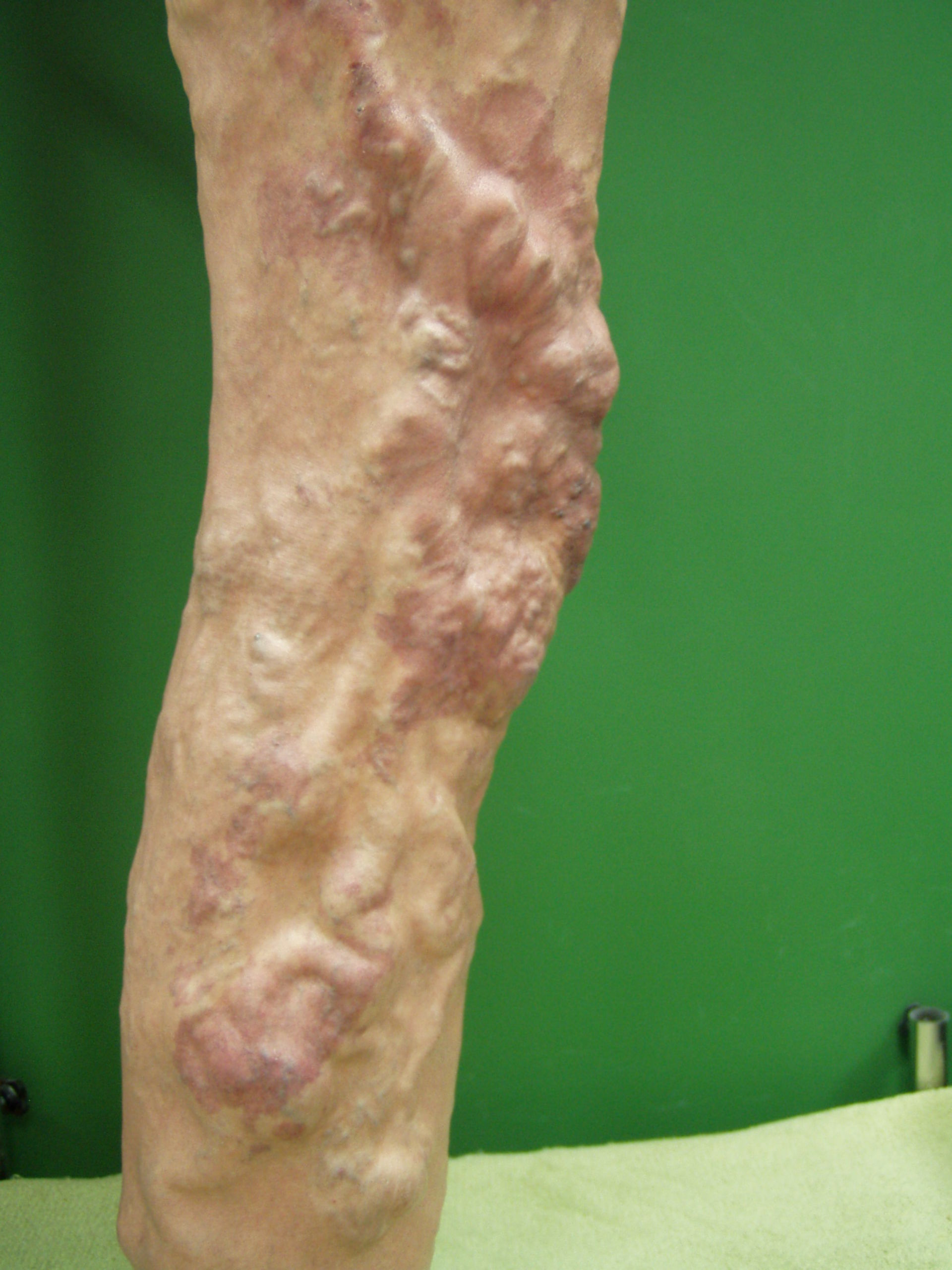 Klippel tranaunay syndrome  by dr.ykshim