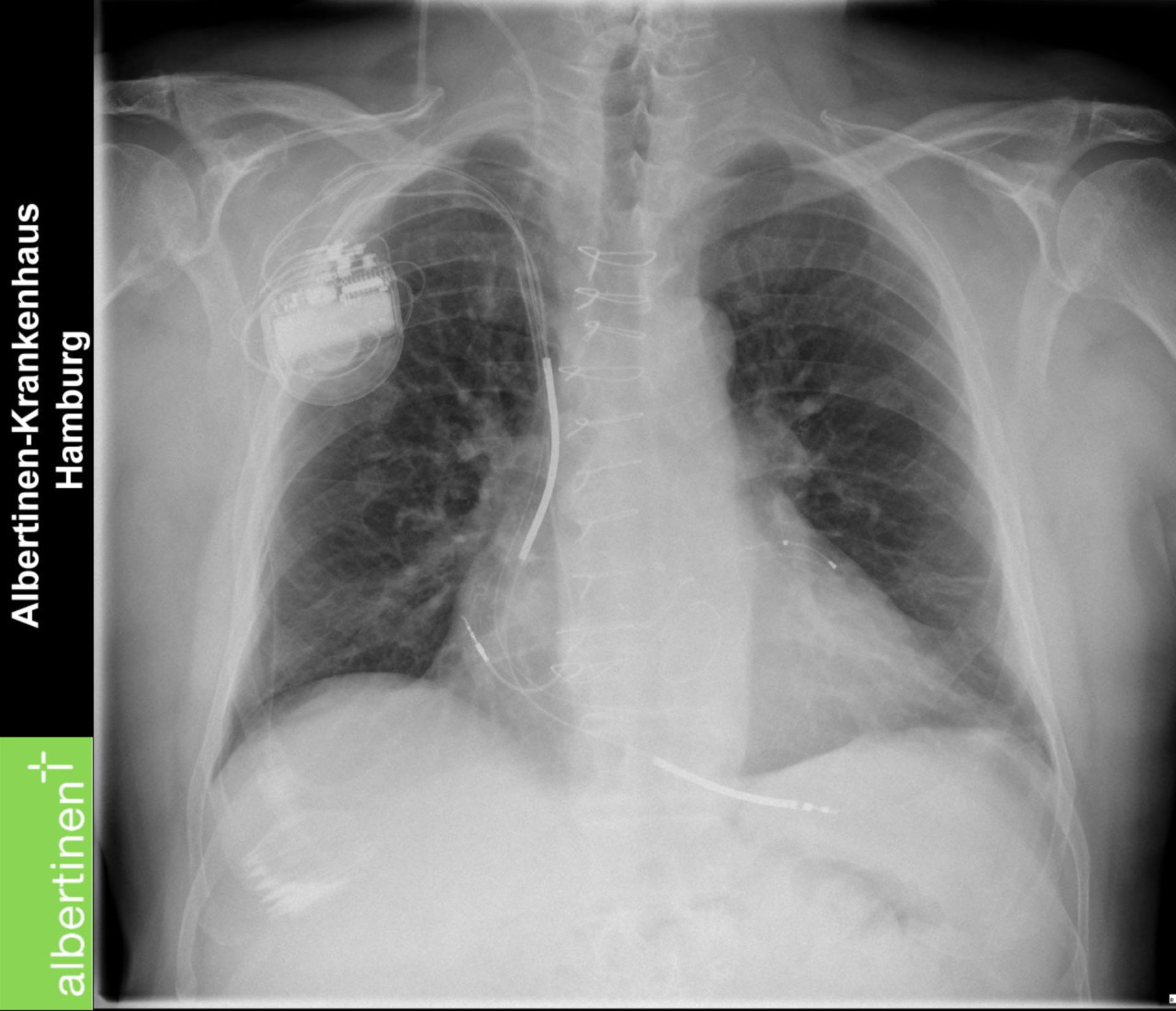 CRT-/A-ICD- pacemaker (X-ray)