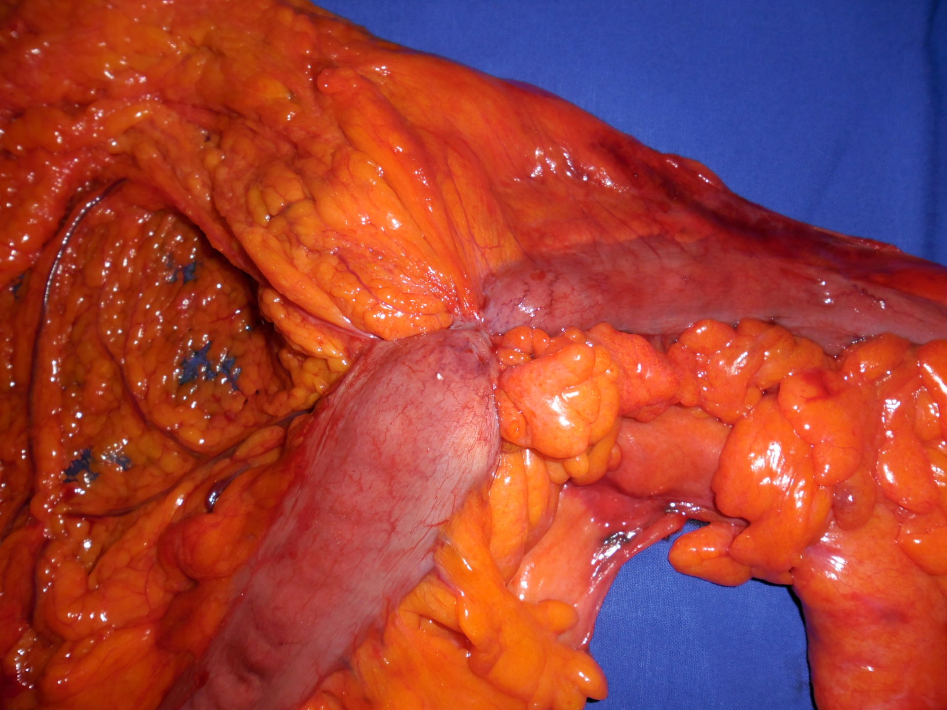 Carcinoma stenosante che lascia una flessione