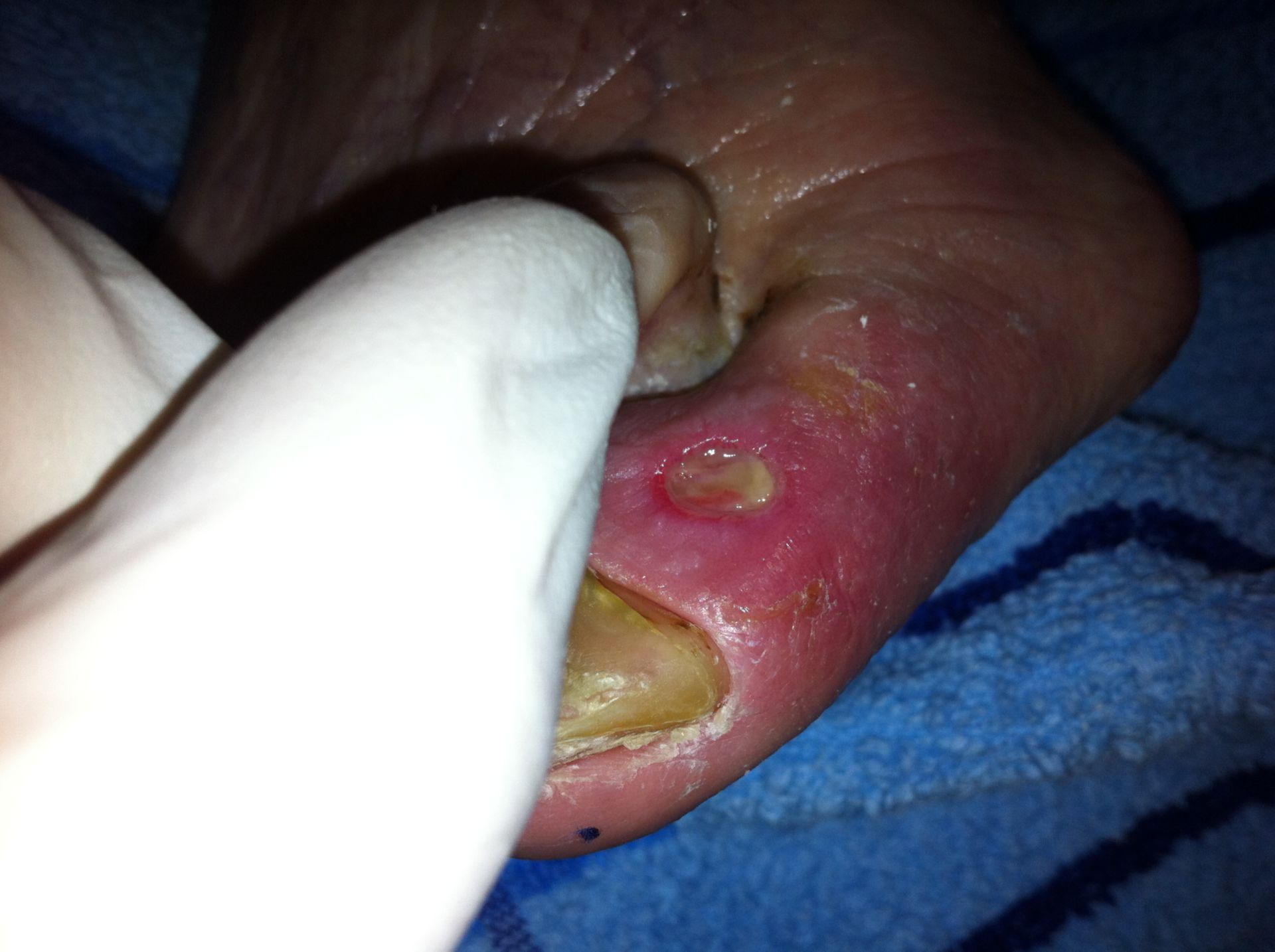 Pressure ulcer D1, right (1)
