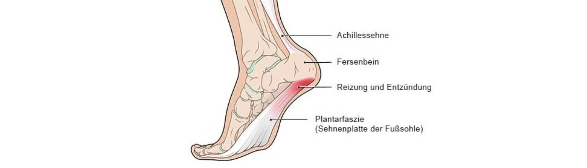 Plantarfasziitis: Schmerz lass endlich nach - DocCheck