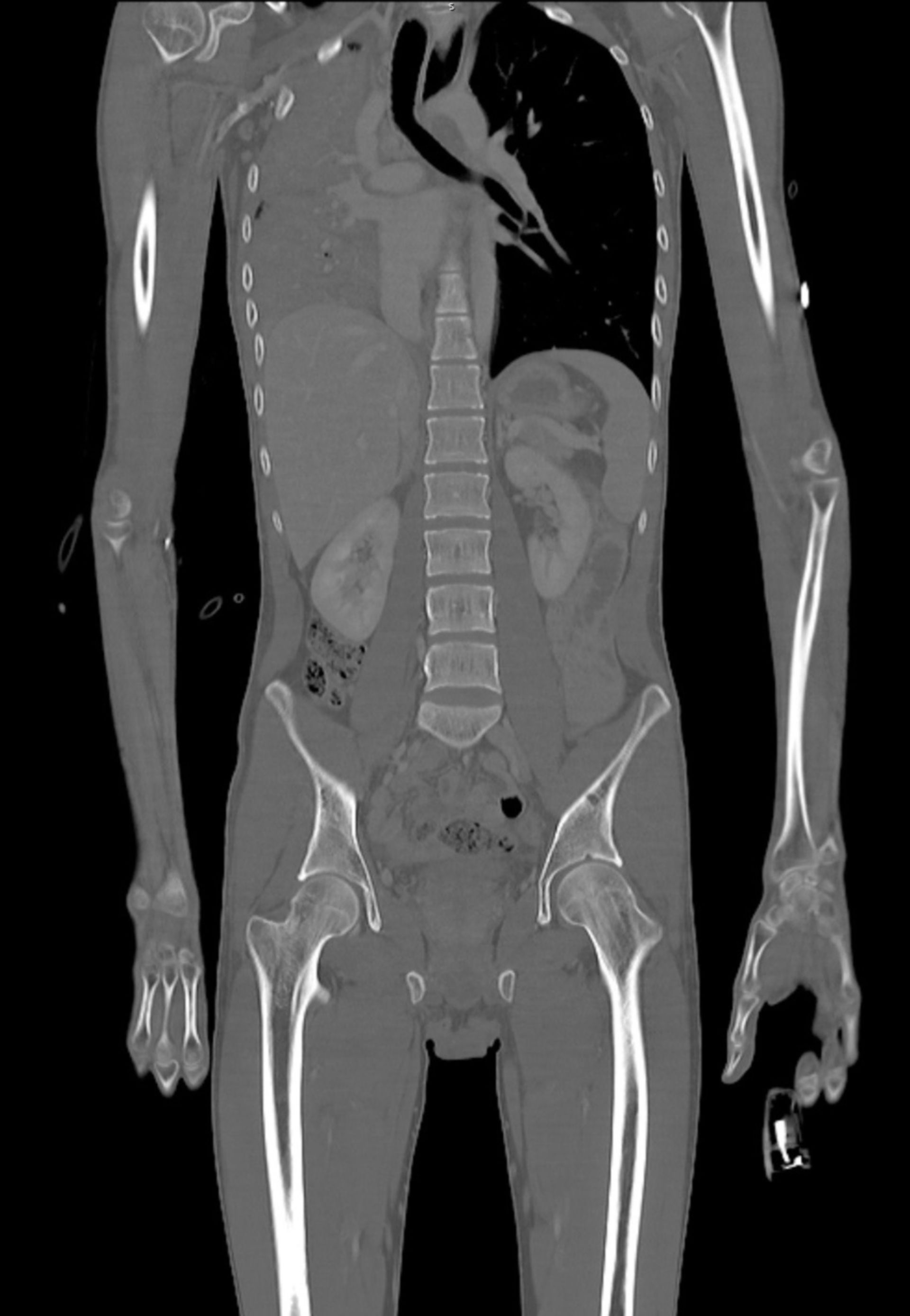 Ganzkörper-CT in frontaler Ebene (Knochenfenster)