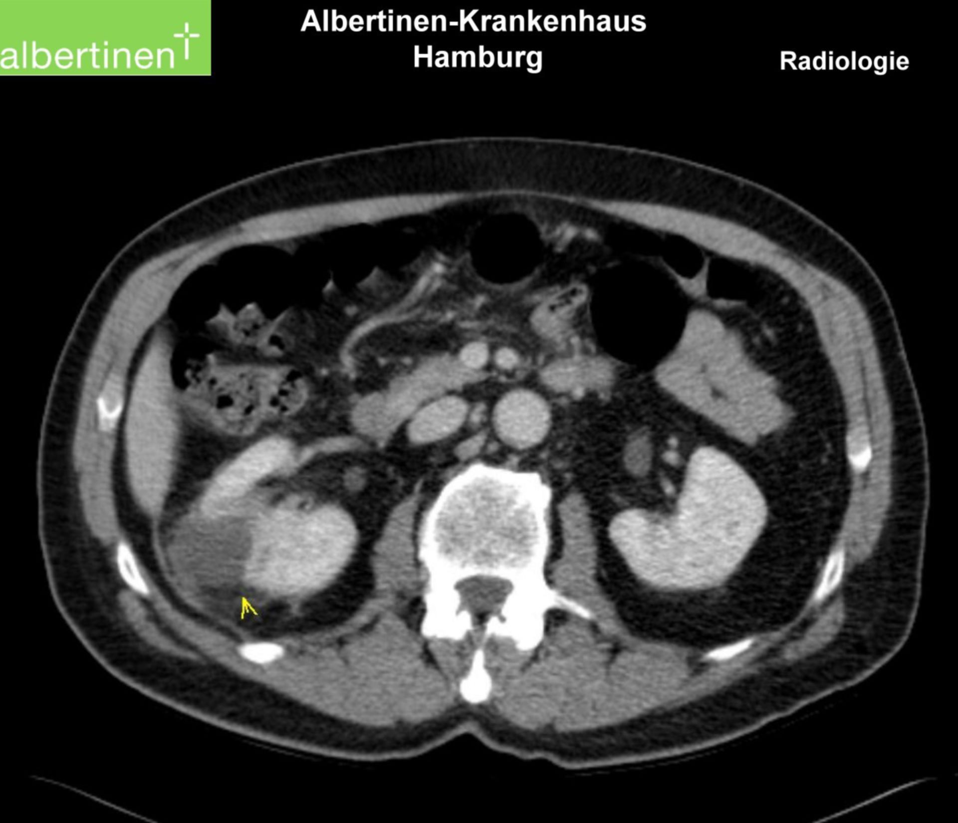 renal abscess, CT