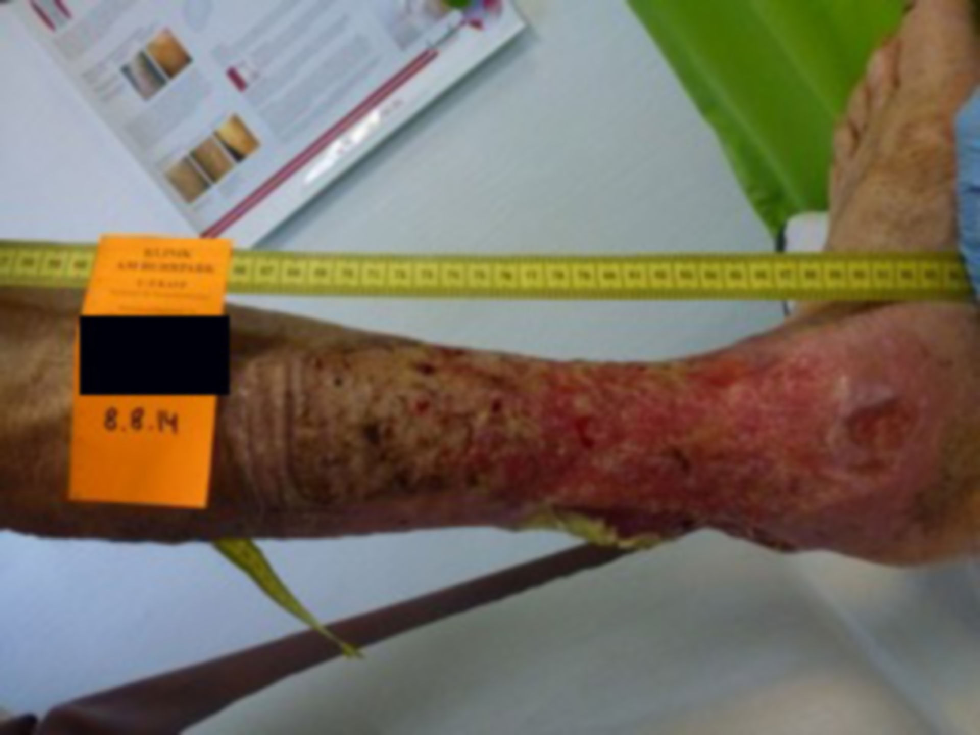 Ulcer of the lower leg - open for 40 years (23)