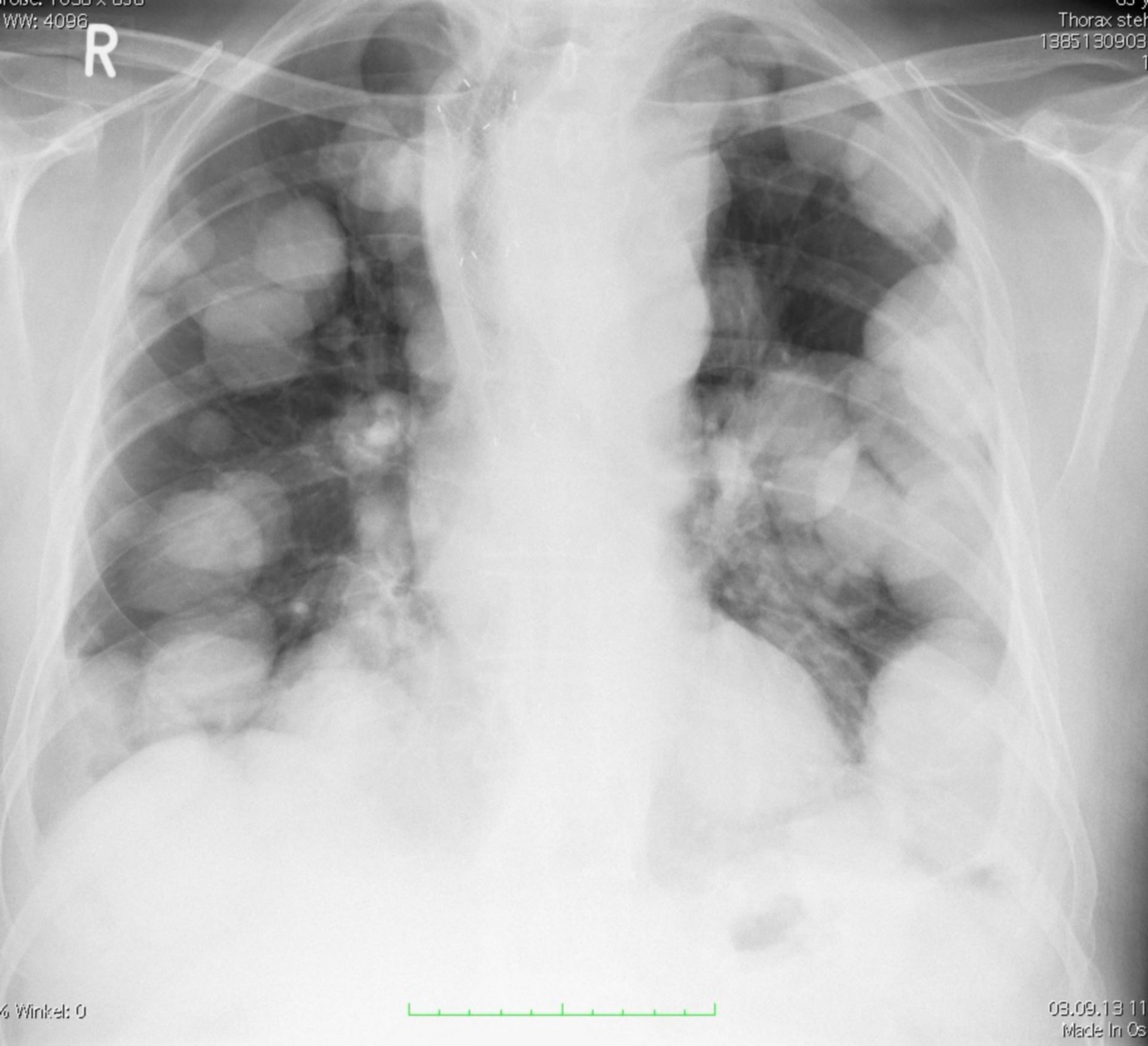 Enfermedad metastásica de los pulmones en cácner esofagico 2